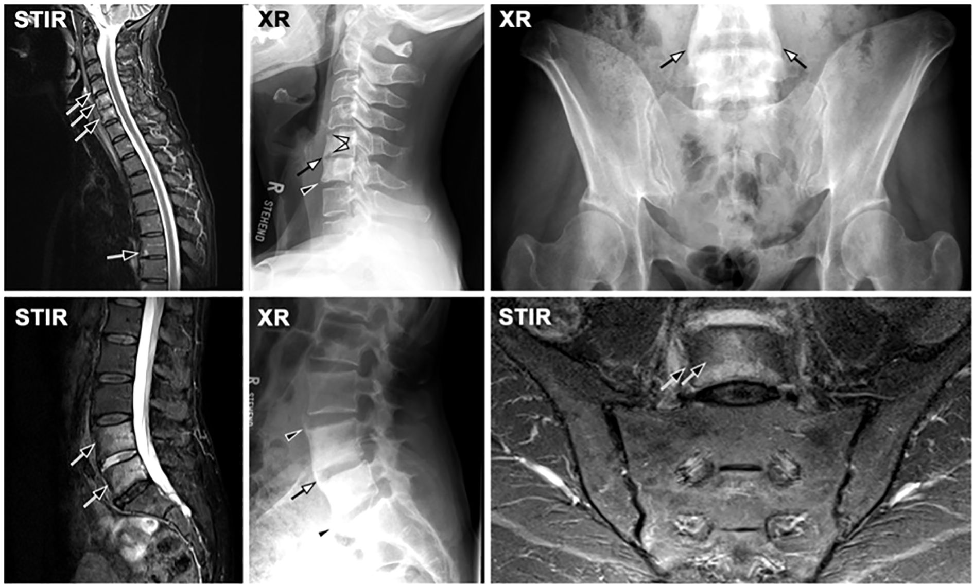 MRI and X-ray images showing various sections of the spine and pelvic region. Arrows highlight specific areas of interest, indicating abnormalities or points of examination. The images include sagittal and frontal views, using STIR and XR imaging techniques. Each image provides a different perspective on the spinal or pelvic anatomy for medical assessment.
