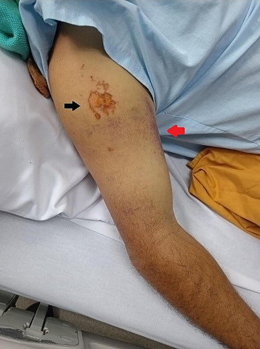 A person's arm showing a bruise and a reddish-brown skin discoloration under the shoulder. The arm rests on a white surface with a blue garment partially visible above the arm.