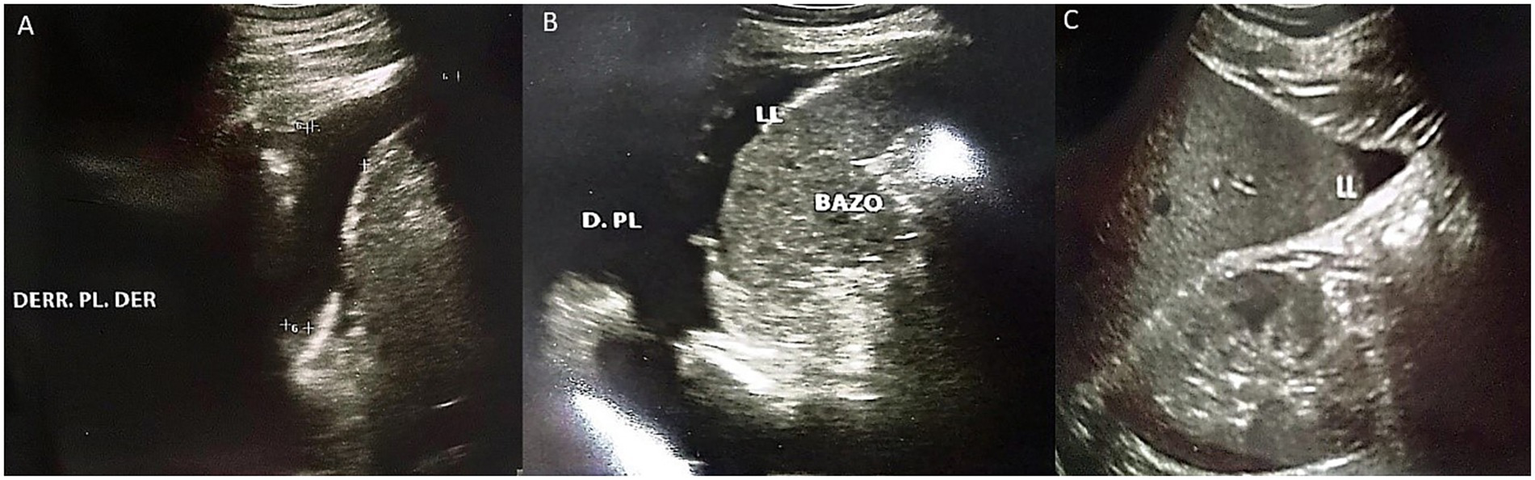 Three-panel ultrasound images labeled A, B, and C. Image A shows a region marked "DERR. PL. DER." Image B depicts areas labeled "D. PL" and "BAZO". Image C includes a label "LL". The images display internal structures in grayscale, commonly examined in medical diagnostics.