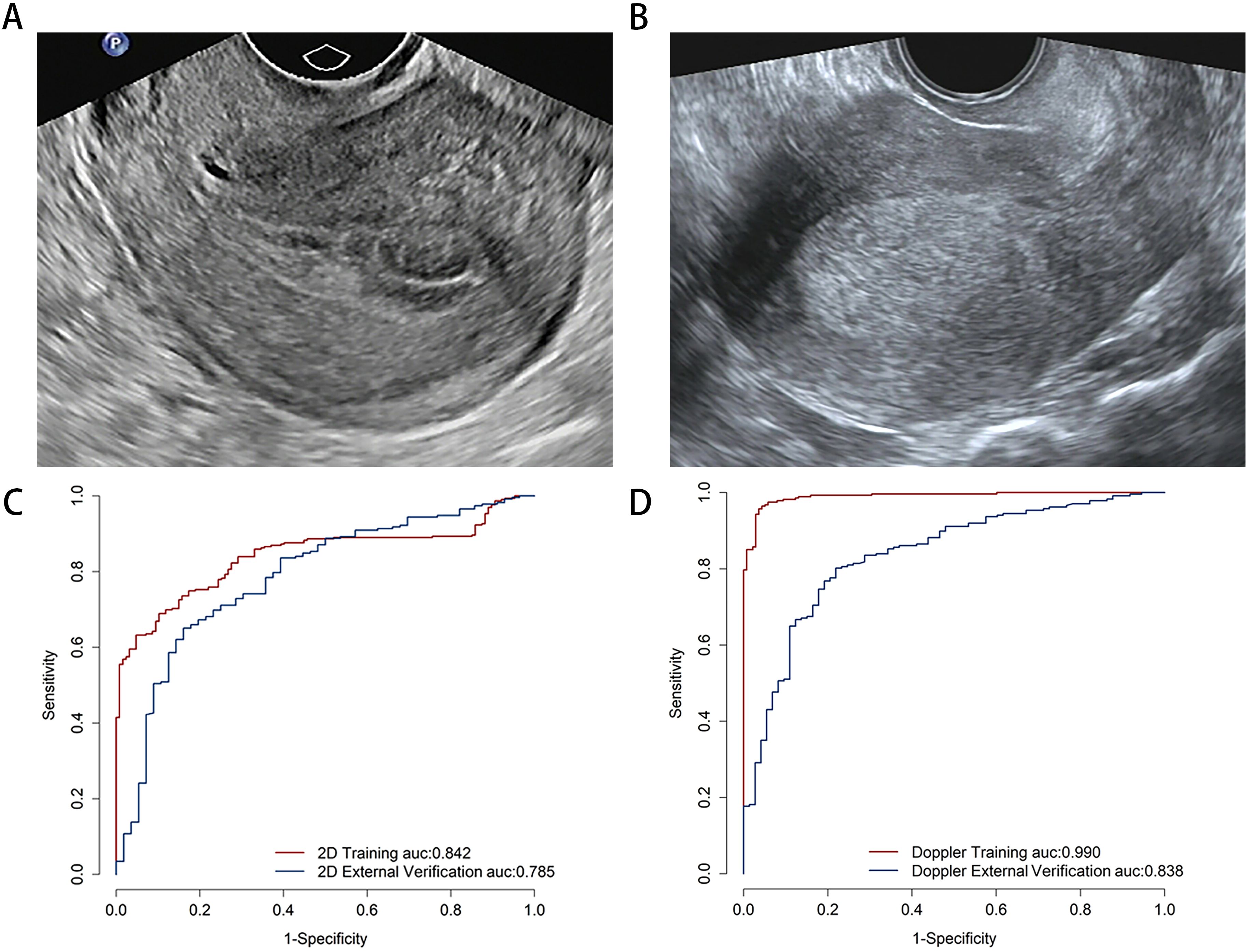 Ultrasound images A and B show different internal structures. Graphs C and D are ROC curves displaying sensitivity versus one minus specificity. Graph C shows 2D training with an AUC of 0.842 and external verification AUC of 0.785. Graph D shows Doppler training with an AUC of 0.990 and external verification AUC of 0.838.