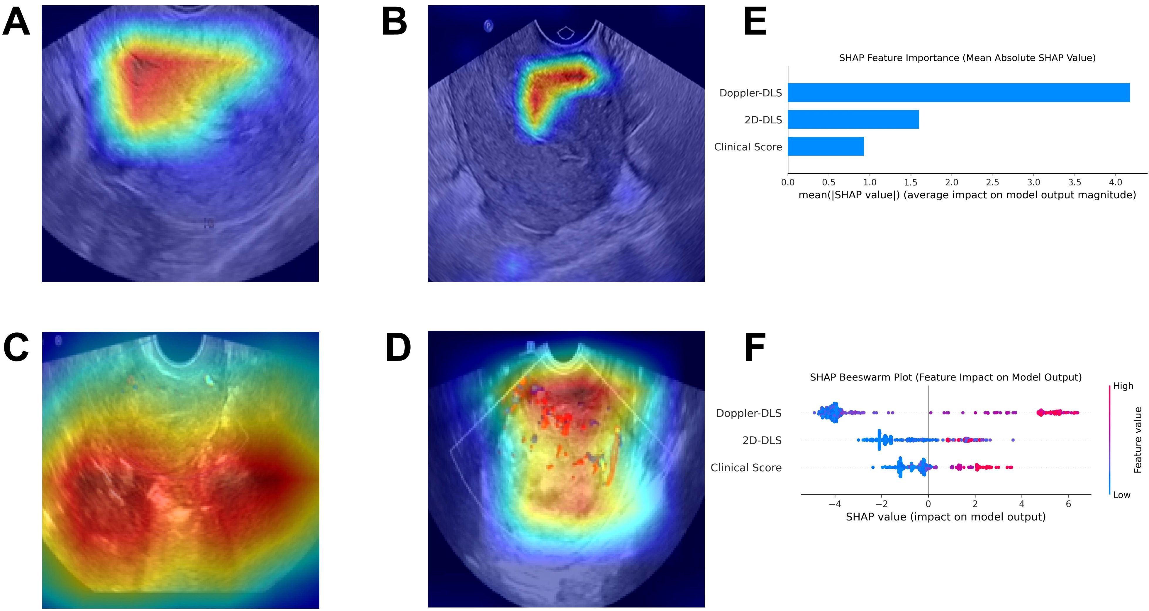 Ultrasound images labeled A, B, C, and D show color-coded heatmaps indicating areas of interest in fetal imaging. Graph E, a bar chart, illustrates the mean absolute SHAP value for Doppler-DLS, 2D-DLS, and Clinical Score, with Doppler-DLS showing the highest impact. Graph F, a beeswarm plot, depicts SHAP values across features, highlighting Doppler-DLS and 2D-DLS scores with varying impact and value distributions.