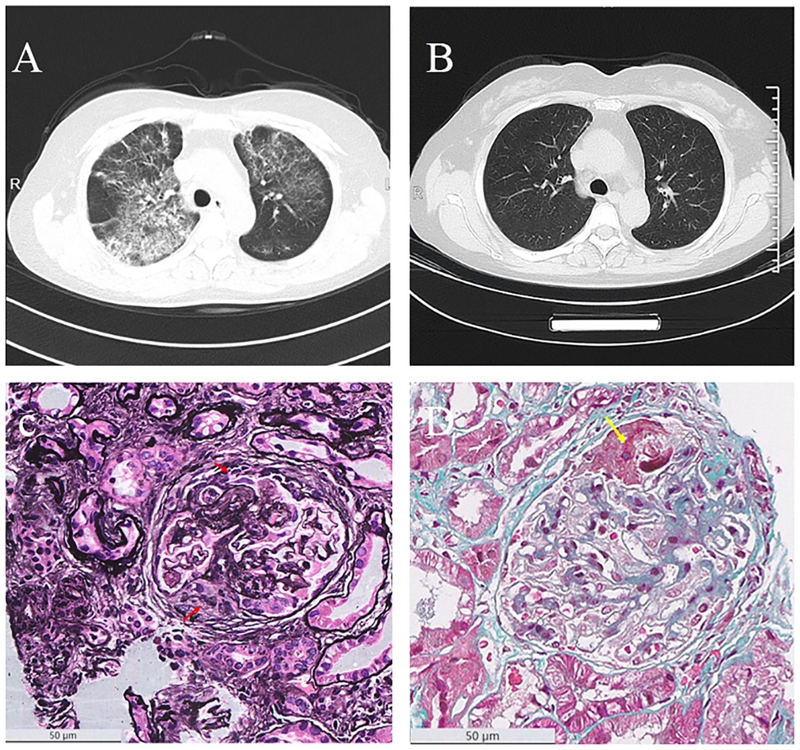 Panel A shows a CT scan with lung abnormalities, while Panel B shows a clear CT scan. Panel C displays a kidney biopsy with cellularity in pink and purple hues. Panel D shows a kidney biopsy stained with blue and red, highlighting structures. Both biopsy panels include scale bars.