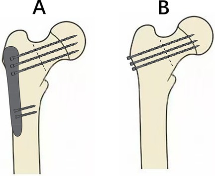 Diagram featuring two methods of femoral fracture fixation. Image A shows a metal plate fixed with screws on the side of the femur. Image B depicts three screws inserted directly into the femoral head. A red dashed line indicates the fracture line in both images.