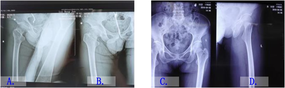 X-ray images of the pelvic and hip regions. Image A shows a close-up of a fractured femur. Image B displays a pelvic fracture. Image C depicts an intact pelvis. Image D shows a hip joint, indicating potential bone irregularities.