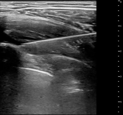 An ultrasound image displaying a cross-section view of ultrasound-guided serratus anterior plane block in children. Under the guidance of the ultrasound probe, the puncture needle sequentially passes through the latissimus dorsi and serratus anterior muscles, reaching the lateral surface of the rib (deep to the serratus anterior). The needle tip is slightly withdrawn, and injection is initiated, resulting in the spread of fluid within the fascial plane between the deep surface of the serratus anterior muscle and the rib/intercostal muscles, forming a hypoechoic area.