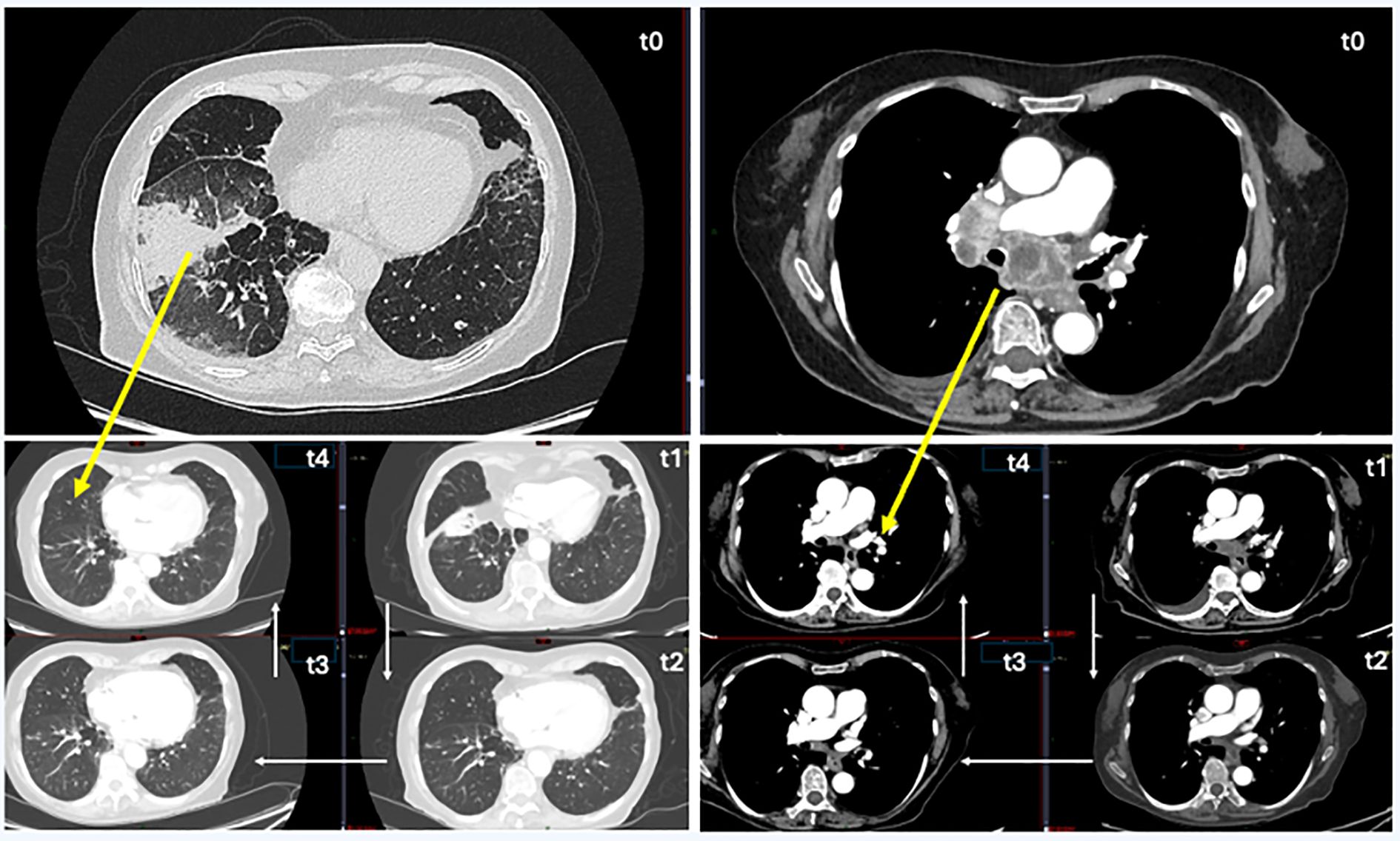 CT scan images showing various cross-sections of the chest at different time points (t0 to t4). Yellow arrows highlight specific areas in the lungs and chest region for analysis. The images display differences in tissue characteristics across time.