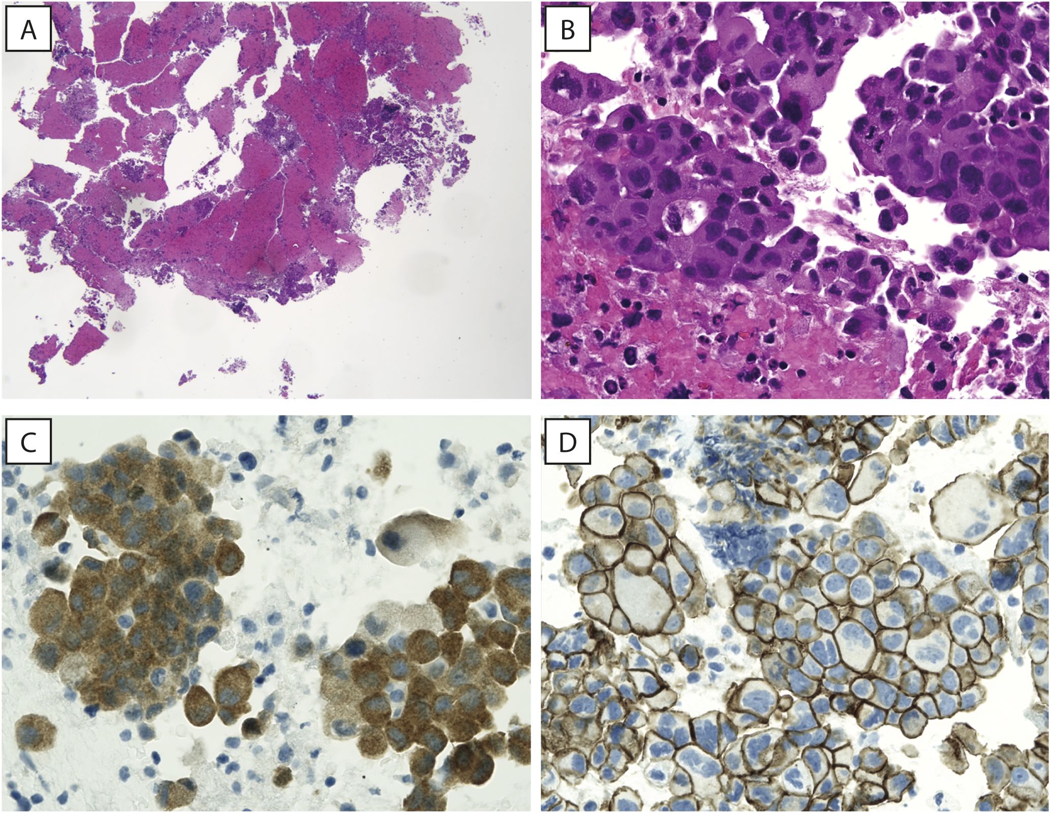 Panels show microscopic images of tissue samples. Panel A displays a low magnification view with scattered clusters of cells stained in pink and purple. Panel B provides a closer view of densely packed cells with prominent nuclei. Panel C presents cells with brown staining, indicating specific marker expression. Panel D shows cells with distinct cell membrane staining, appearing in blue and brown.