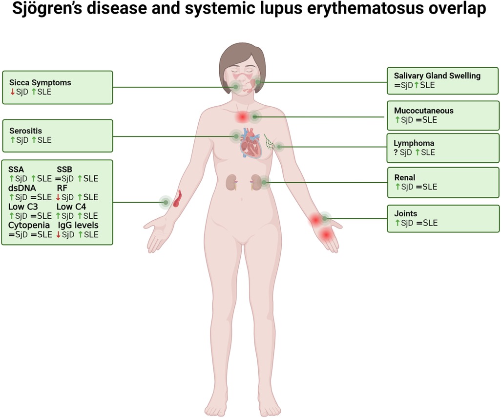 Diagram showing an overlap between Sjögren’s disease and systemic lupus erythematosus (SLE) with a human figure highlighting affected areas. Sections indicate symptoms such as sicca symptoms, serositis, salivary gland swelling, mucocutaneous symptoms, lymphoma, renal issues, and joint problems. Boxes list specific markers like SSA, SSB, RF, dsDNA, low C3 and C4, and cytopenia, showing variations in Sjögren’s disease and SLE involvement.