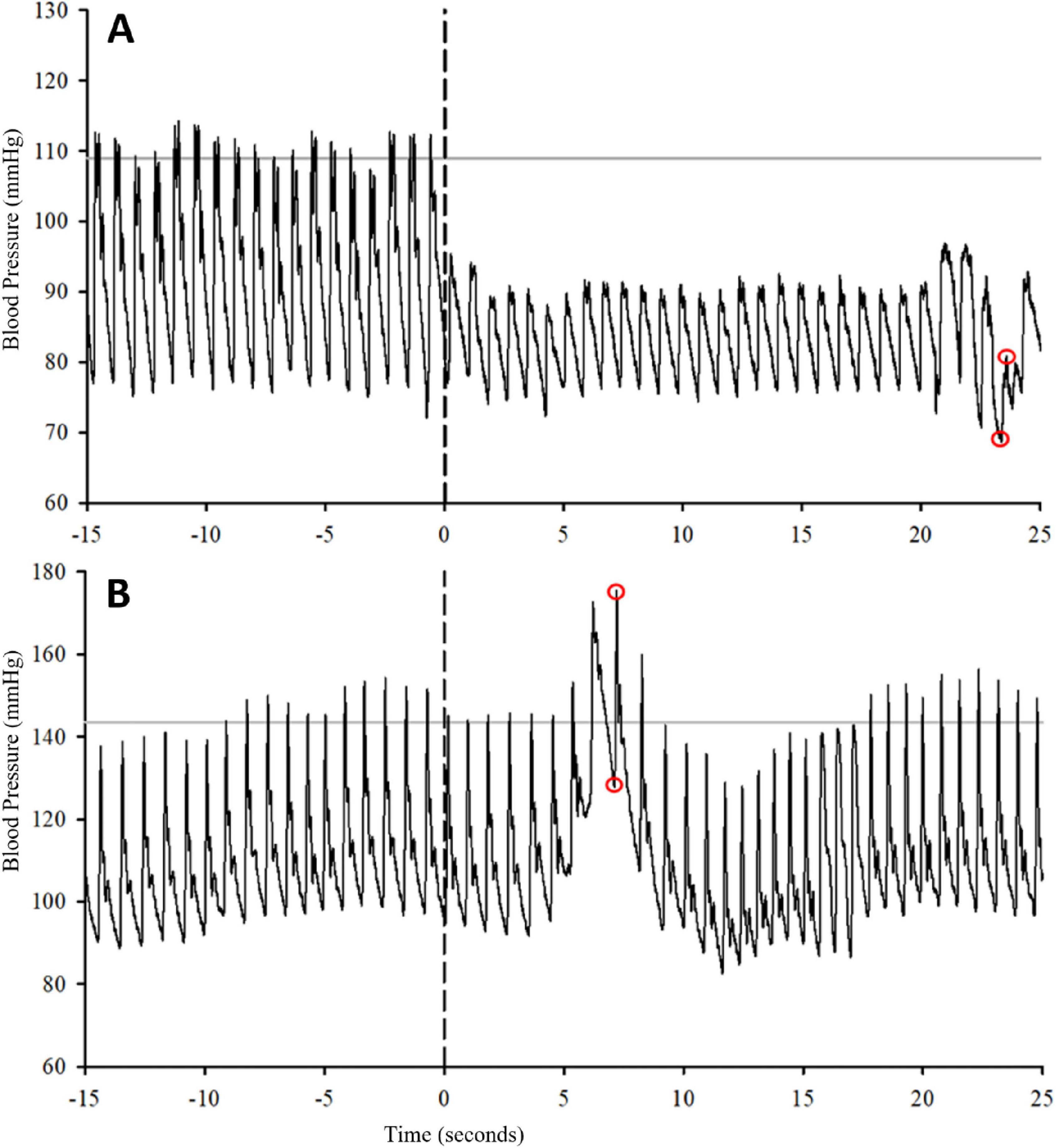 Graph A and B display blood pressure (mmHg) over time (seconds). Graph A shows blood pressure starting at 110 mmHg and dropping to approximately 90 mmHg. Graph B shows a higher baseline blood pressure, spiking after 6 seconds. Both graphs have marked peaks and troughs.