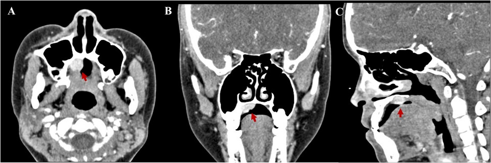 Three-panel medical imaging showing CT scans of the skull. Panel A displays an axial view highlighting a region with a red arrow. Panel B shows a coronal view with another red arrow indicating a specific area. Panel C presents a sagittal view, again with a red arrow marking a point of interest. All arrows draw attention to similar structures within the nasal region.