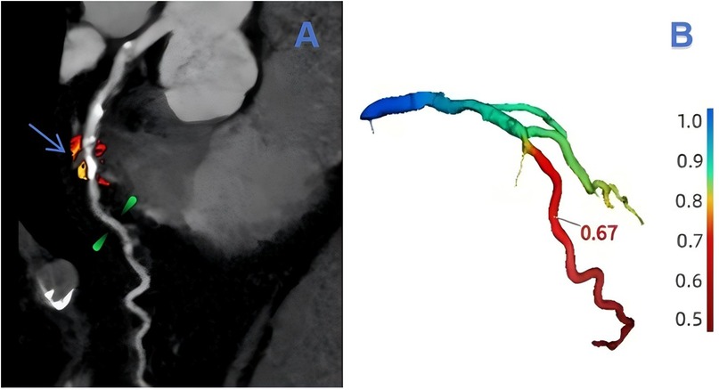 Medical imaging comparison featuring two panels. Panel A shows a grayscale image of a vessel with color highlights indicating sections, an arrow pointing at a particular area. Panel B depicts a color-coded 3D model of the vessel, ranging from blue to red, with a number 0.67 marked on a section, corresponding to perfusion or flow values on a scale from 0.5 to 1.0.