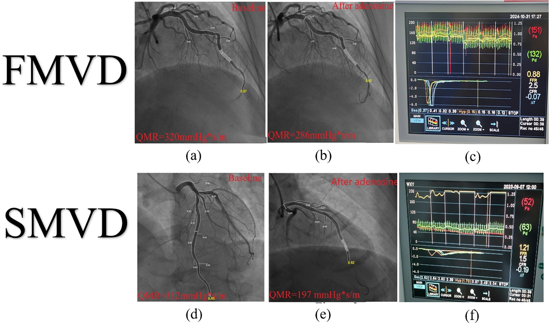Medical images show angiographic and graphical data related to coronary flow. (a) and (b) depict baseline and post-adenosine flow for FMVD, showing QMR values of 320 and 286 mmHg*s/m. (c) displays corresponding physiological graphs. (d) and (e) show baseline and post-adenosine flow for SMVD with QMR values of 312 and 197 mmHg*s/m. (f) includes related charts. The images highlight changes in coronary blood flow and measurements.
