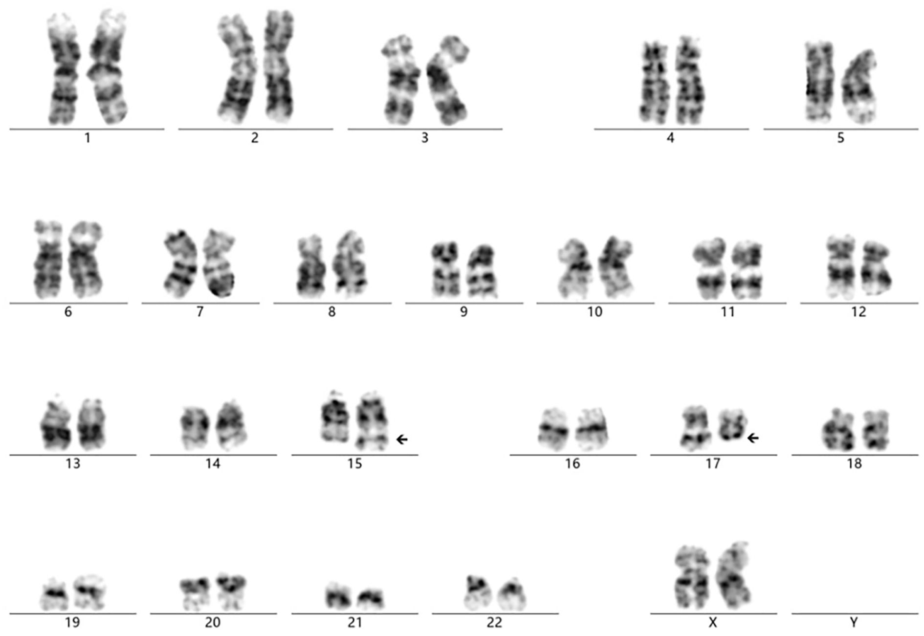 Karyotype showing a complete set of chromosomes from a human cell, arranged in pairs from one to twenty-two, followed by the sex chromosomes X and Y. Chromosome fifteen and seventeen are indicated with arrows.
