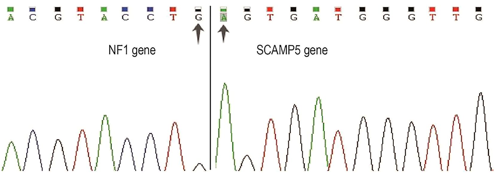 DNA sequencing chromatogram showing nucleotide sequences for the NF1 and SCAMP5 genes. Peaks represent sequences with letters A, C, G, T in colors green, blue, black, and red, respectively. Arrows highlight specific nucleotides in both genes.