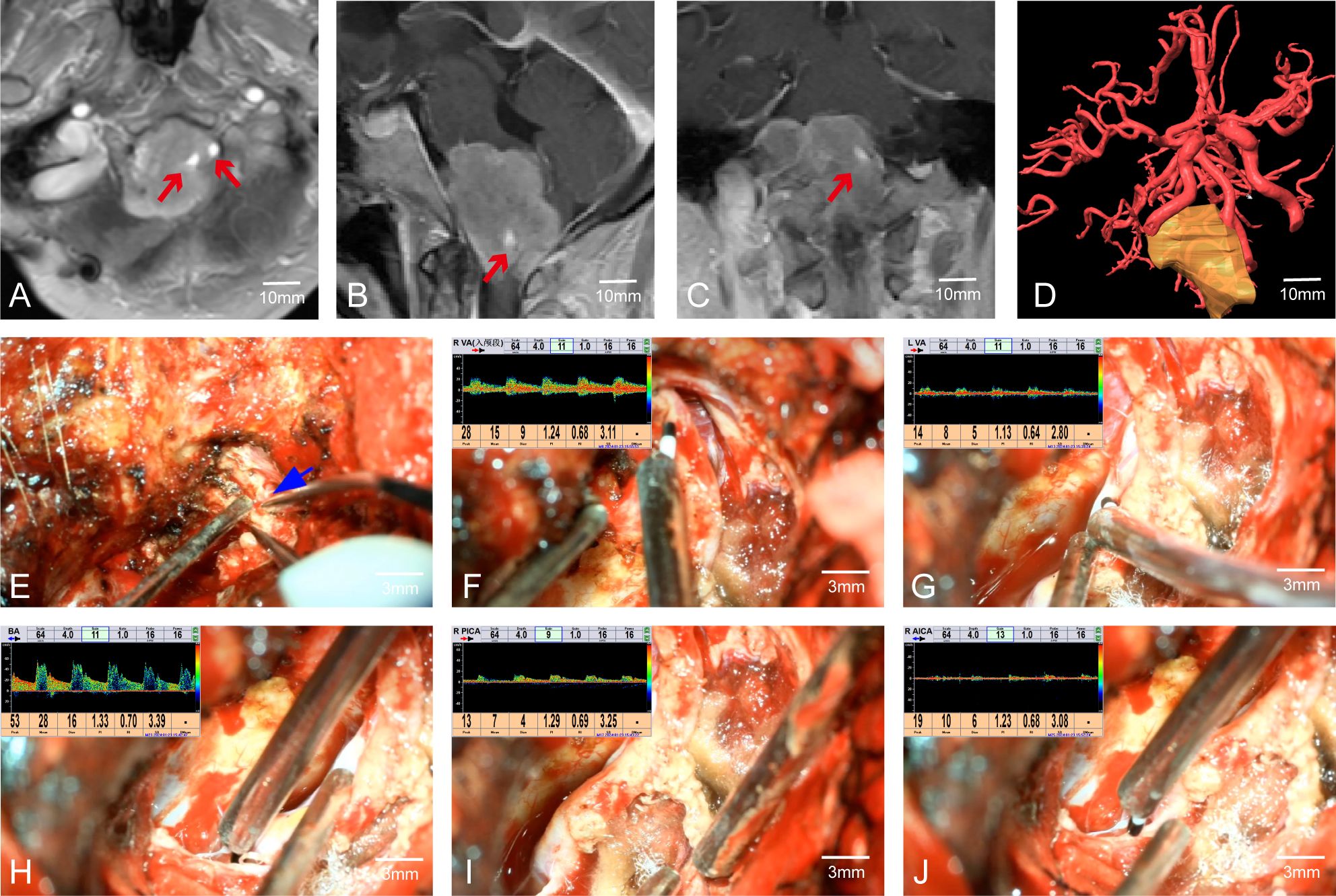 MRI images labeled A, B, and C show a brain mass indicated by red arrows. D is a 3D visualization of the brain’s vascular system. Images E to J depict surgical views of the brain with instruments and monitoring graphs. Blue arrows and measurement scales in millimeters provide size references.
