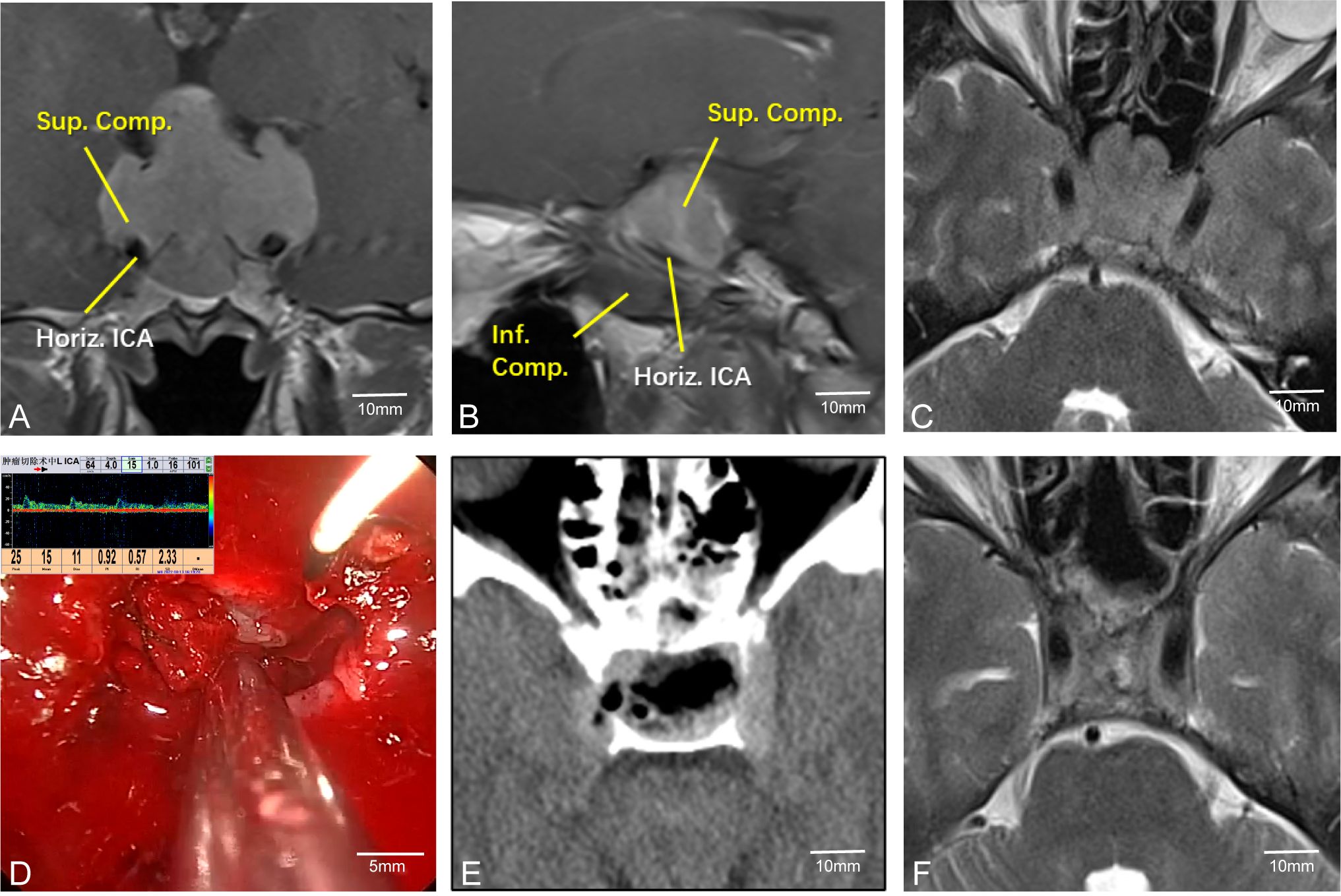 MRI and CT scans with surgical imagery of the cavernous sinus region. Images A and B, labeled with “Sup. Comp.”, “Inf. Comp.”, and “Horiz. ICA”, show areas of interest. Image C shows another MRI view. Image D features a surgical procedure with a Doppler reading overlay. Image E is a CT scan of the sinus area. Image F offers a final MRI view. Scale bars indicate size reference.