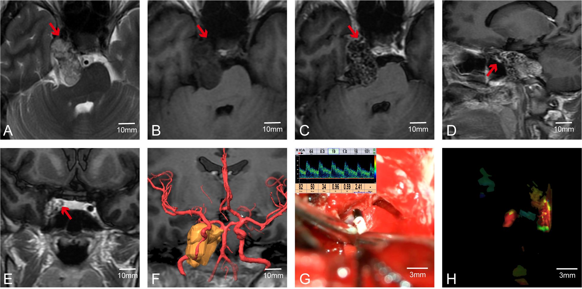Medical imaging sequence depicting various scans and illustrations. Panels A to E show MRI images with red arrows indicating specific areas of interest; the MRI scans have different perspectives and highlight brain features. Panel F features a 3D reconstruction of blood vessels, with a marked area. Panel G displays a surgical view with inset showing a Doppler waveform. Panel H presents a functional imaging scan with colored regions. Each image has a scale for reference.