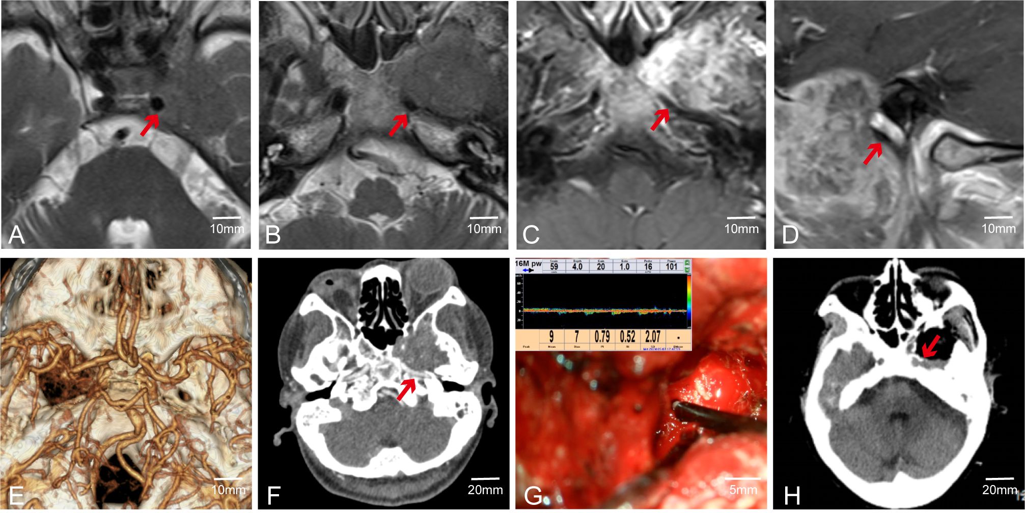 A series of medical images showing different views of the brain. Panels A to D display MRI scans highlighting areas with red arrows, indicating regions of interest. Panel E shows a 3D reconstruction of blood vessels. Panel F is a CT scan with another arrow highlighting a specific area. Panel G features an intraoperative photograph. Panel H shows a post-operative CT scan with an arrow indicating changes. Each image has a scale bar for reference.