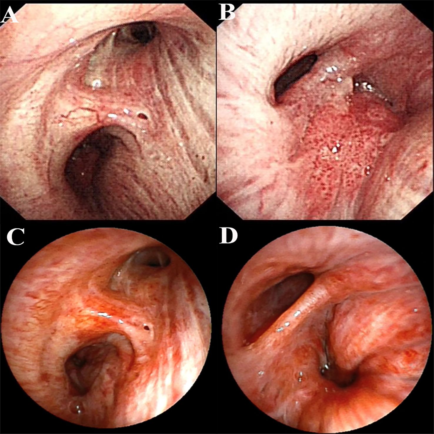 Four endoscopic images labeled A, B, C, and D show varying views of vocal cords. A and C depict the abduction phase with open glottis and visible throat structures. B and D illustrate the adduction phase where the vocal cords are closed, showing irritated tissues. Each image highlights differences in tissue coloration and structural visibility.