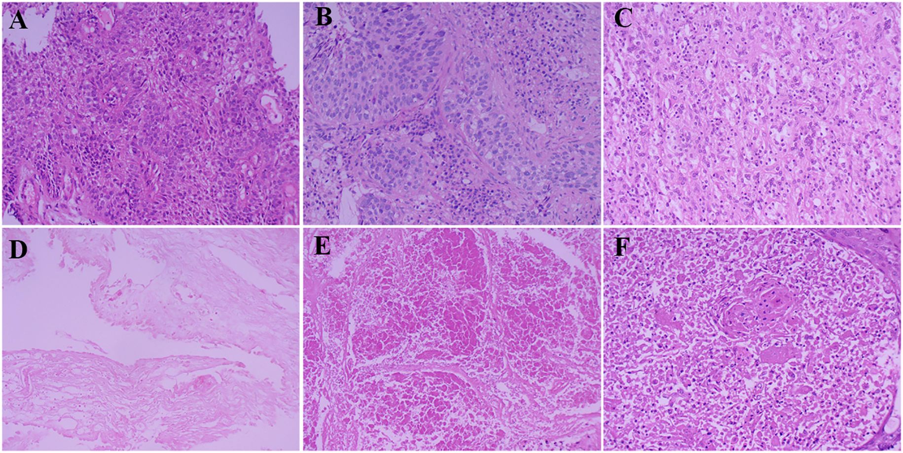 Histopathological images labeled A to F show various tissue samples stained with hematoxylin and eosin. Each panel illustrates distinct cellular structures and arrangements. Panel A shows densely packed cells, B displays closely arranged nuclei, C has a more fibrous appearance, D shows sparse connective tissue, E presents a dense network of fibers, and F depicts cellular infiltration with surrounding fibrous structures.