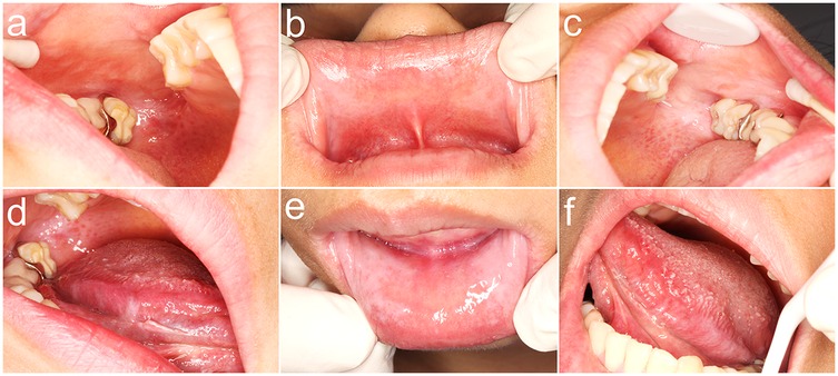 Close-up images of the inside of a person's mouth, arranged in a grid. Panels a, c, and d show the upper and lower teeth along with the gums, with dental fillings visible on molars. Panel b shows the inside of the lower lip. Panel e displays the underside of the tongue being lifted, while panel f shows the tongue extended upwards within the mouth. The images illustrate dental and oral cavity features.
