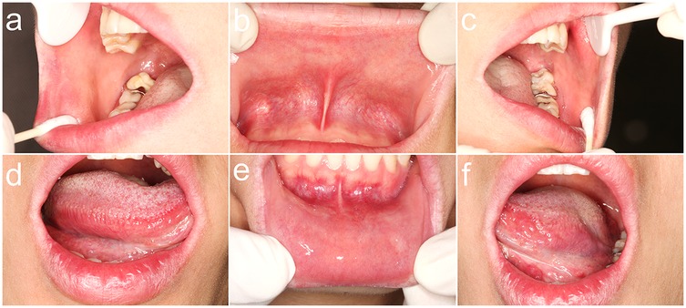 Close-up images of different parts of the mouth and oral cavity. Panel a shows the inside cheek and molars. Panel b displays the upper lip interior. Panel c shows the opposite cheek and molars. Panel d reveals the tongue surface and inner mouth. Panel e displays the lower lip interior. Panel f shows the side view of the tongue elevated towards the palate. Each panel is labeled accordingly.
