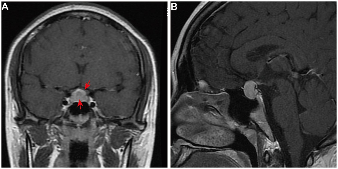 Preoperative MRI. Panel A (coronal view) shows an enlarged pituitary gland with mass effect on the optic chiasm. Panel B (sagittal view) shows an enlarged and homogeneously enhanced pituitary gland.