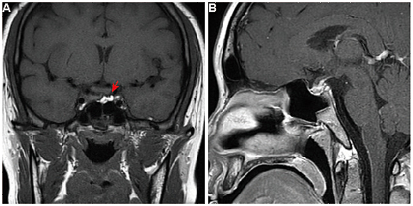Postoperative MRI. Panel A (coronal view) and Panel B (sagittal view) both shows partial resection of the sellar mass.