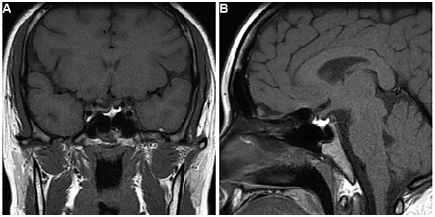 7-year follow-up MRI images. Panel A (coronal view) and Panel B (sagittal view) both shows no expansion of the residual gland.