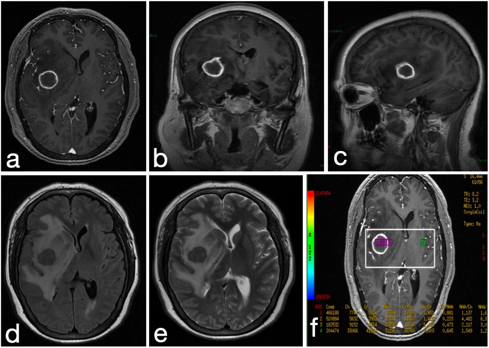 Six-panel MRI scan images of the brain labeled a to f. Panels a, b, and c show enhanced, ring-like structures, indicating contrast uptake in axial, coronal, and sagittal views. Panels d and e display axial T2-weighted images showing hyperintense areas suggestive of edema surrounding the lesion. Panel f contains the axial view with colored overlays for analytical measurements and a rectangular region marked for examination.