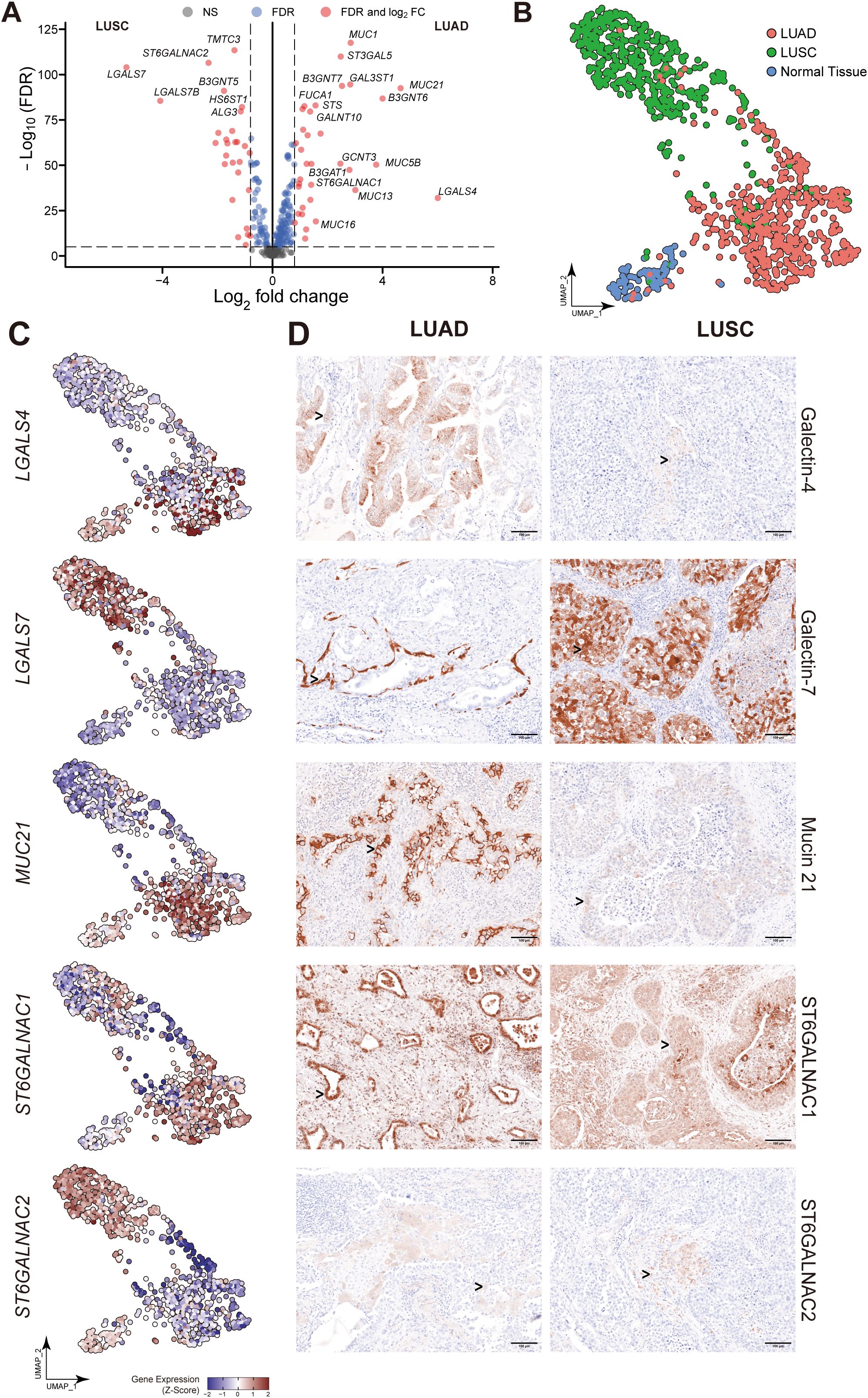 Panel A is a volcano plot showing gene expression changes in LUSC and LUAD, highlighting specific genes like MUC1 and B3GNT5. Panel B is a UMAP plot illustrating clustering of LUAD, LUSC, and normal tissues. Panel C shows gene expression heatmaps for LGALS4, LGALS7, MUC21, ST6GALNAC1, and ST6GALNAC2. Panel D contains immunohistochemistry images for Galectin-4, Galectin-7, Mucin 21, ST6GALNAC1, and ST6GALNAC2, comparing LUAD and LUSC tissues.