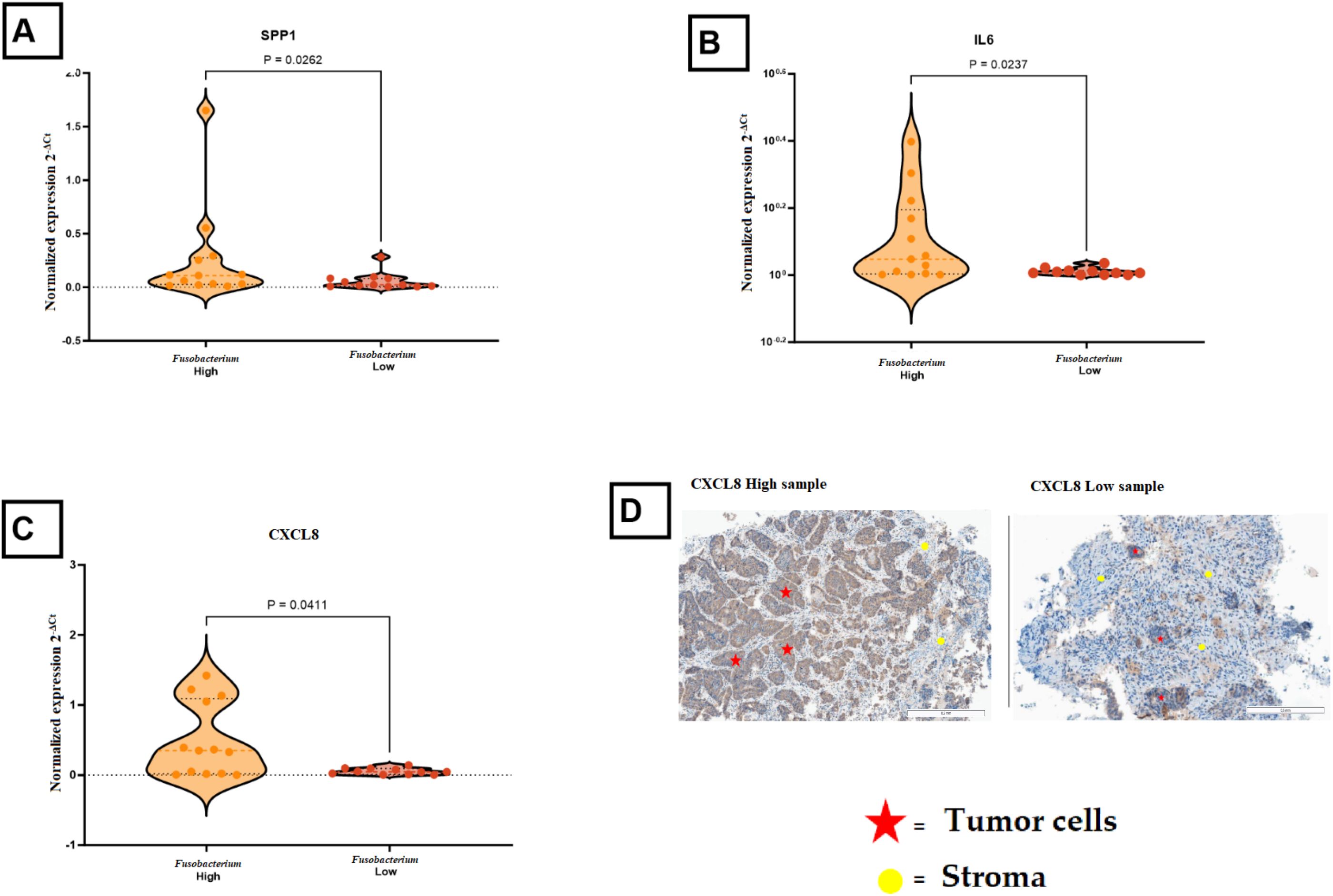 Violin plots labeled A, B, and C compare gene expression levels of SPP1, IL6, and CXCL8 in Fusobacterium high and low samples, showing statistically significant differences. Panel D displays histological images of CXCL8 high and low samples, indicating tumor cells with red stars and stroma with yellow circles.