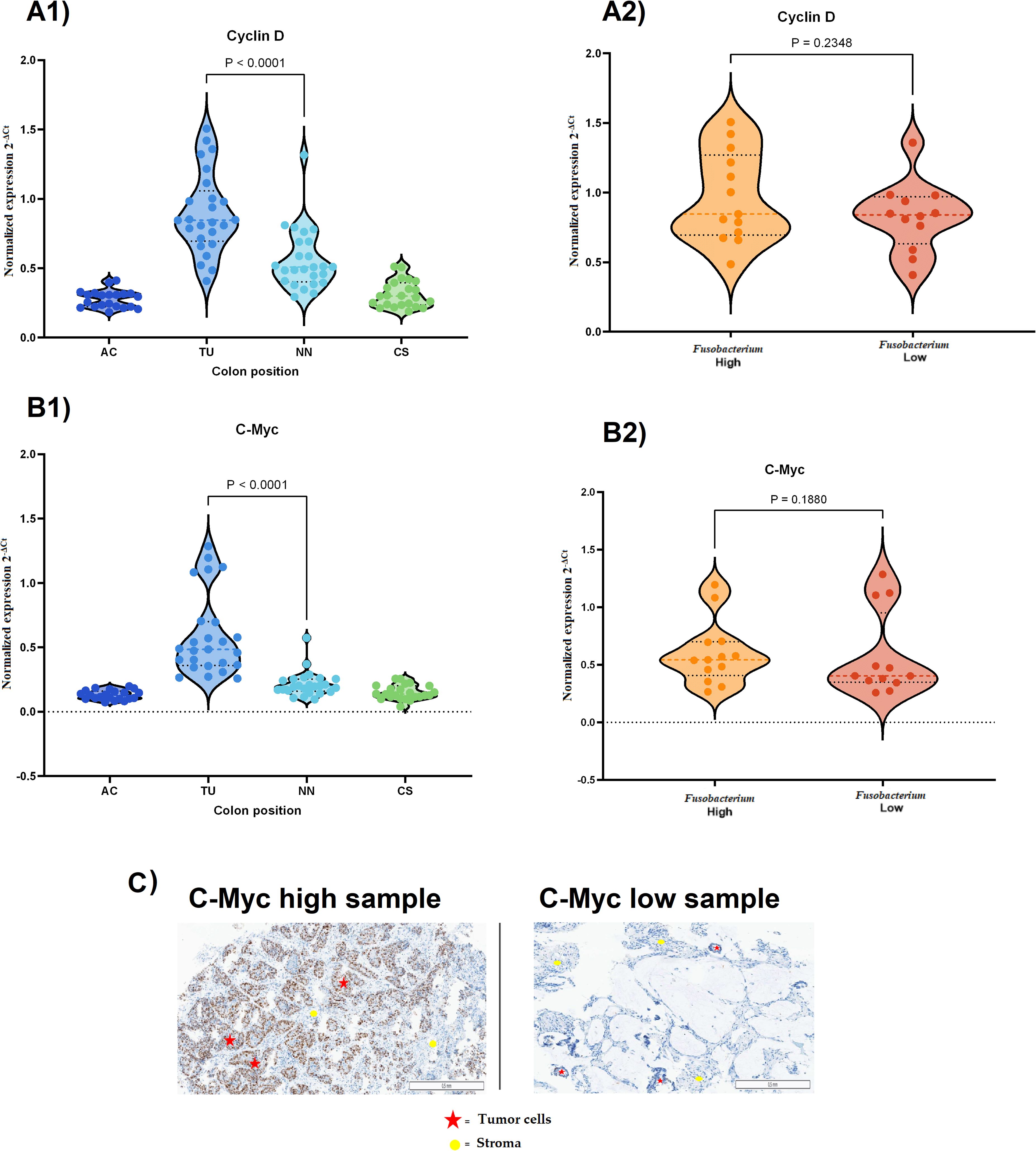 Violin plots and histological images. A1) and B1) show normalized expression of Cyclin D and C-Myc in different colon positions: AC, TU, NN, CS. A2) and B2) compare Cyclin D and C-Myc levels with Fusobacterium status, indicating no significant difference. C) Histology slides display C-Myc levels in samples; tumor cells and stroma highlighted with red and yellow stars, respectively.