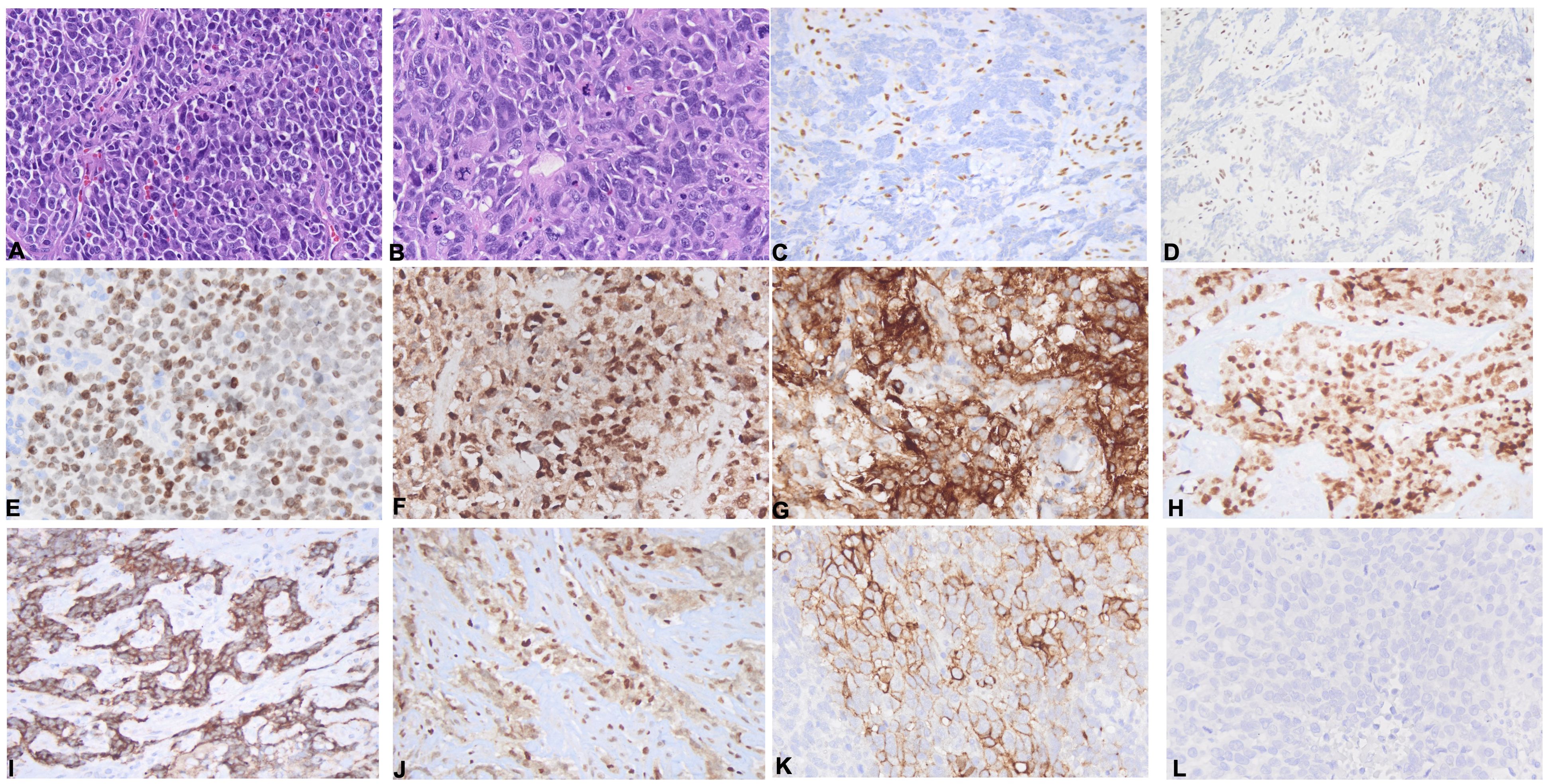Panel of twelve histological images labeled A to L showing tissue samples from different patients to highlight morphologic and immunophenotypic features. The first two images are of hematoxylin and eosin stained slides illustrating morphologic features of thoracic SMARCA4-dUT. The 3rd to the last images are of immunohistochemical stains demonstrating immunophenotypic features of cases of thoracic MARCA4-dUT in this series.
