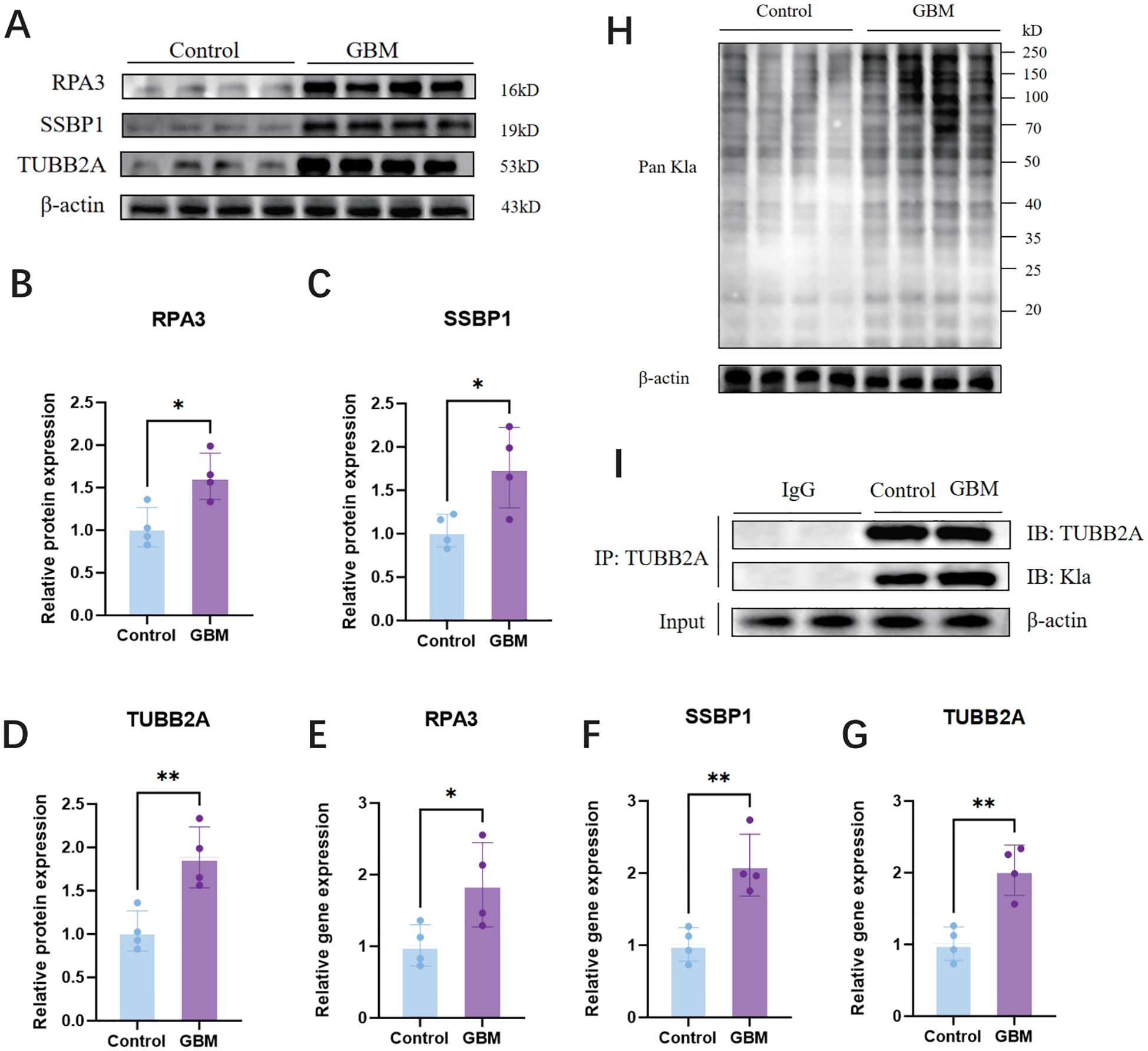 Western blot and bar graphs comparing protein and gene expression in control versus GBM samples. Panel A shows protein bands for RPA3, SSBP1, TUBB2A, and β-actin. Panels B to G display bar graphs indicating increased protein and gene expression in GBM for RPA3, SSBP1, and TUBB2A, with significance marked by asterisks. Panel H shows protein bands for Pan Kla, with β-actin as a control. Panel I displays immunoprecipitation results for TUBB2A, IB: TUBB2A, and β-actin.