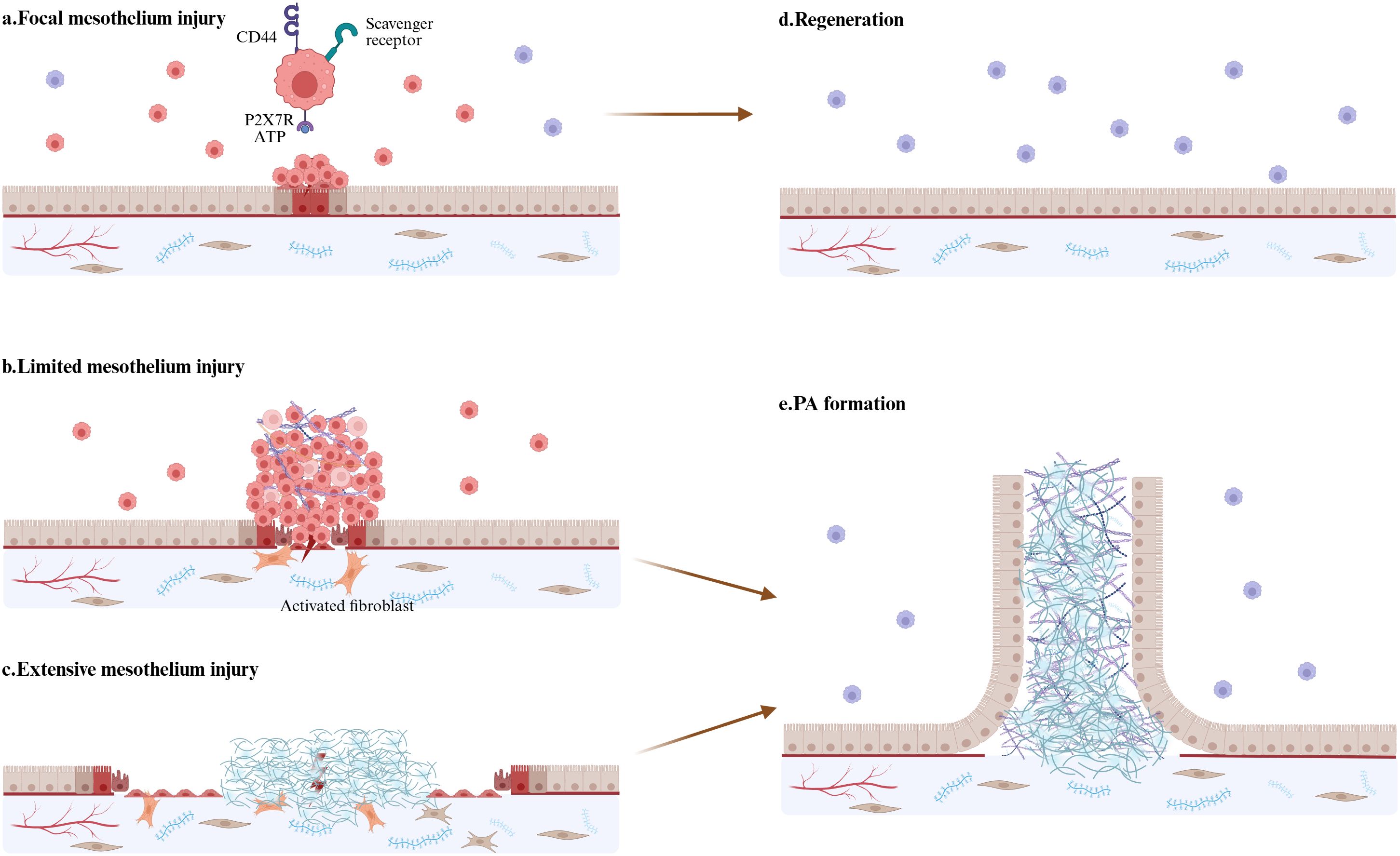 Diagram illustrating mesothelium injury and responses: (a) Focal injury with signaling molecules, (b) limited injury with activated fibroblasts, (c) extensive injury leading to fibrosis, (d) regeneration, (e) PA formation with accumulated cellular and fibrous materials.