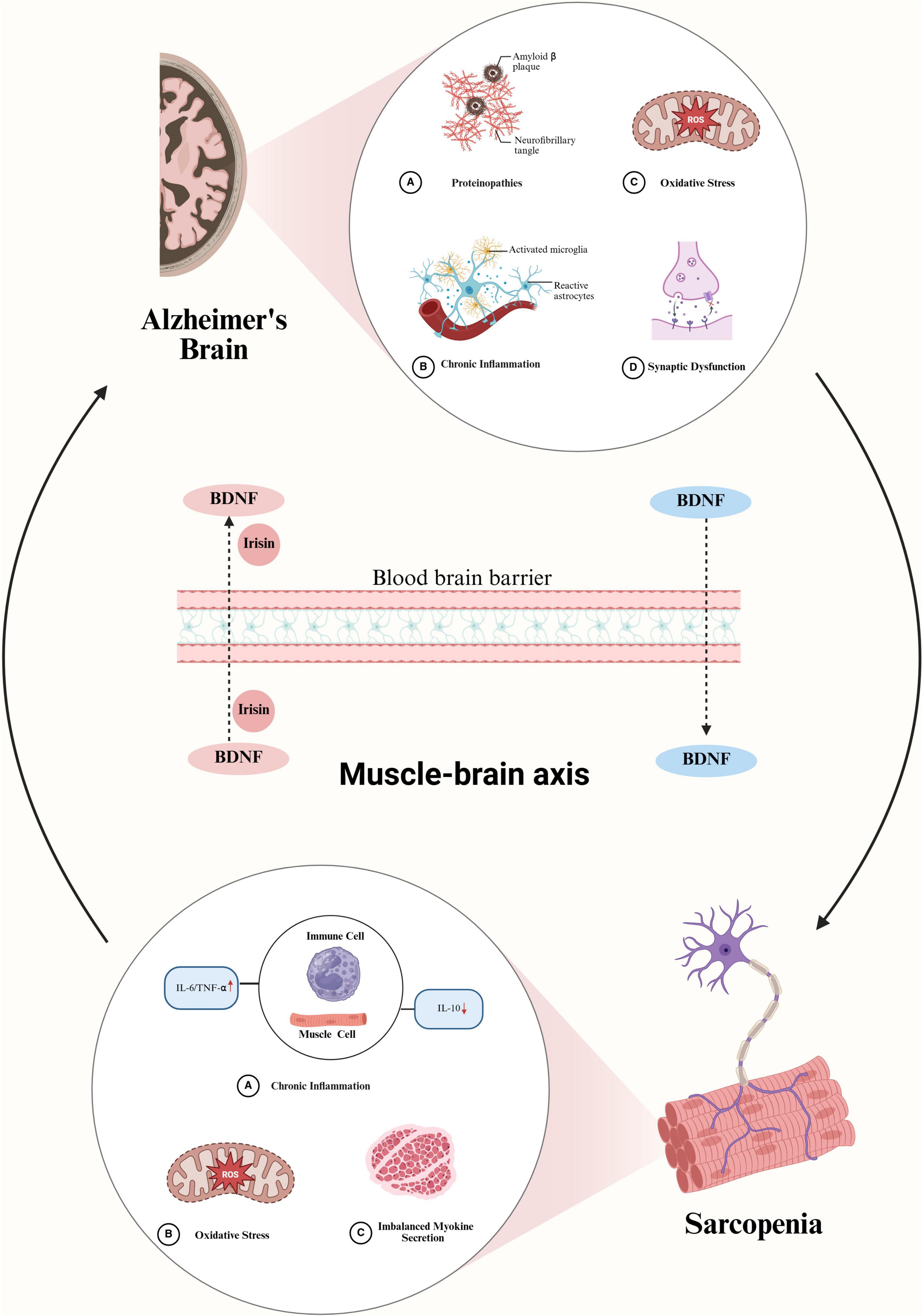 Diagram depicting the connection between Alzheimer’s and sarcopenia via the muscle-brain axis. The upper section illustrates Alzheimer’s brain with proteinopathies, chronic inflammation, oxidative stress, and synaptic dysfunction. Below, the muscle-brain axis shows irisin and BDNF crossing the blood-brain barrier. The lower section shows sarcopenia with chronic inflammation, oxidative stress, and imbalanced myokine secretion. The flow arrows indicate interaction between brain and muscle.
