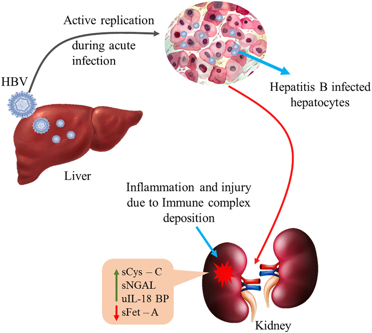 Active HBV replication in the hepatocytes elicits immune response resulting in inflammation and kidney injury due to immune complex deposition. sCys-C, serum cystatin-C; sNGAL, serum neutrophil gelatinase associated lipocalin; sFet-A, serum fetuin-A; uIL-18BP, urinary interleukin-18 binding protein. Green arrow indicates up-regulation of sCys-C, sNGAL and uIL18BP while red arrow indicates down-regulation of sFet-A in circulation. Supplementary FIGURE 1 Kaplan Meier analysis for assessing early kidney injury.