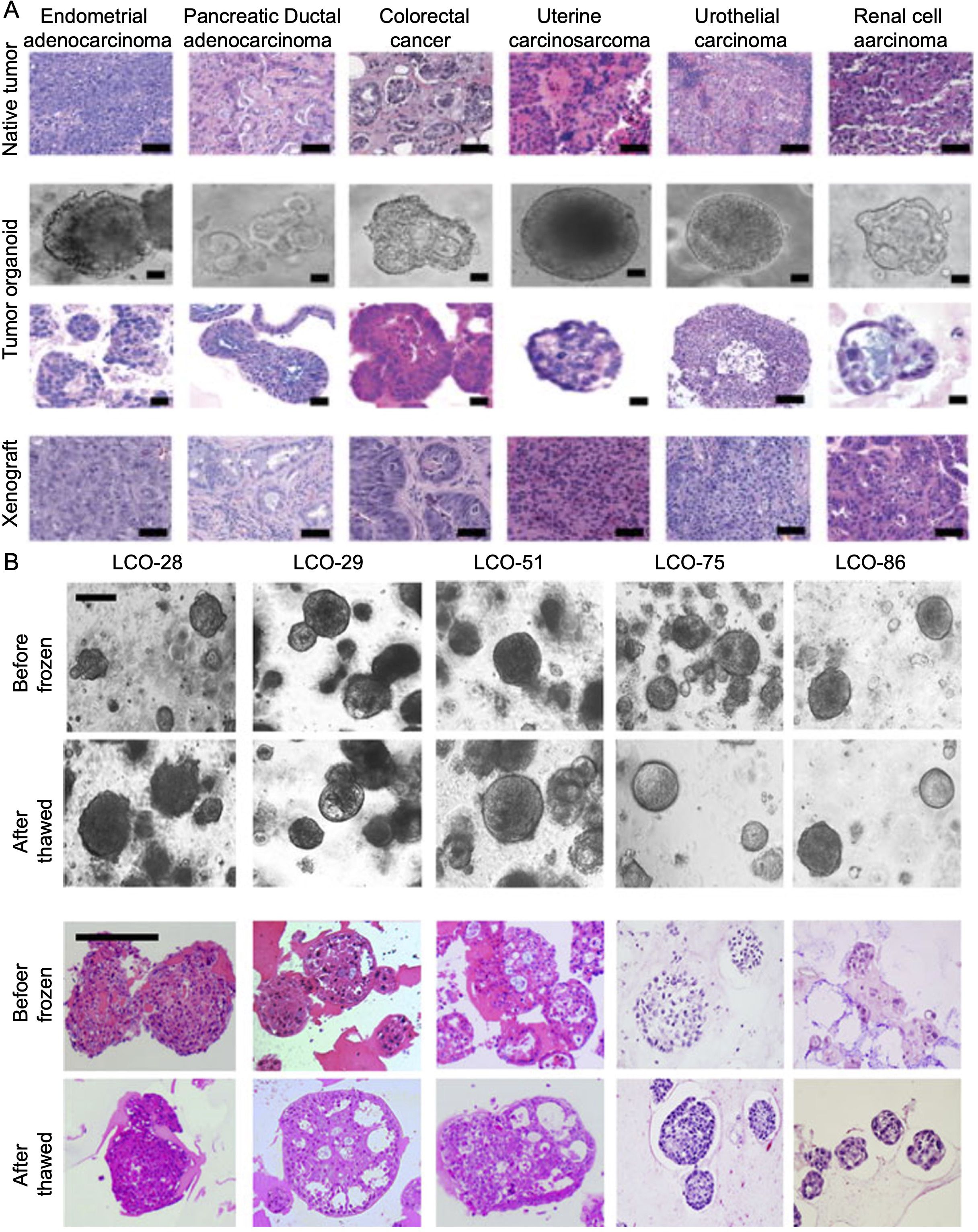 Panel A displays microscopic images of various cancer types, including endometrial adenocarcinoma, pancreatic ductal adenocarcinoma, colorectal cancer, uterine carcinosarcoma, urothelial carcinoma, and renal cell carcinoma. Each cancer type is shown in native tumor form, as a tumor organoid, and as a xenograft. Panel B illustrates organoids (LCO-28, LCO-29, LCO-51, LCO-75, and LCO-86) before freezing and after thawing, with grayscale and stained images before and after treatment.