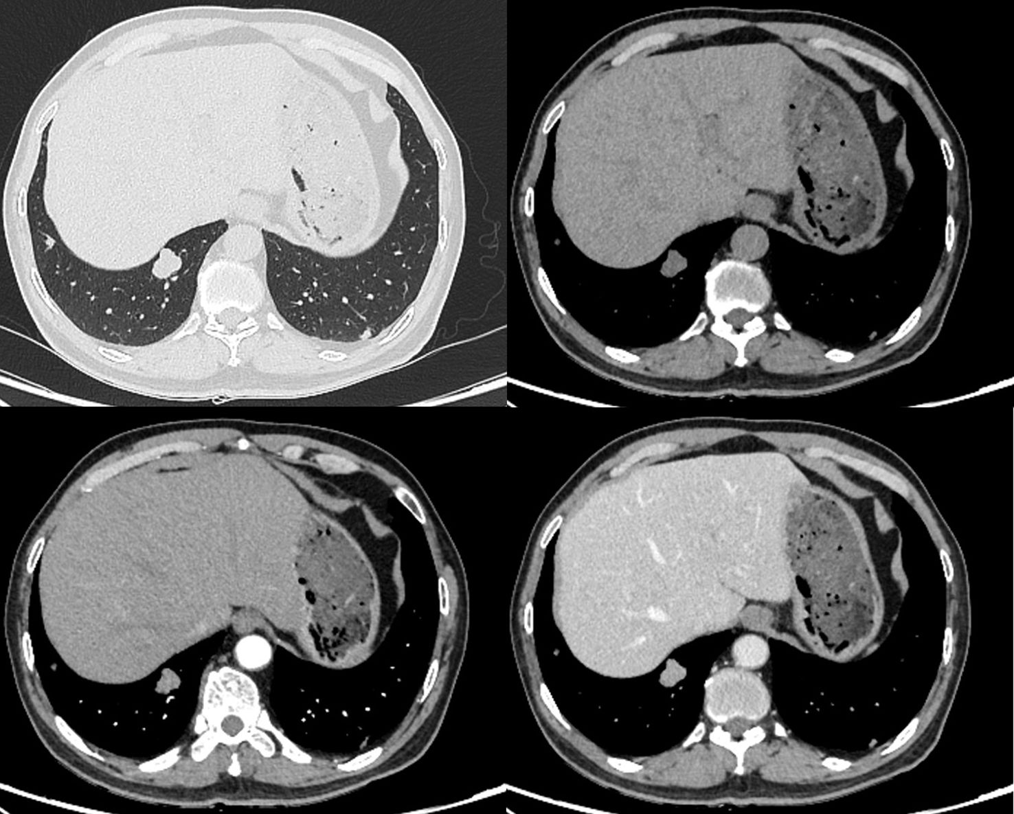 Four CT scan images showing different abdominal cross-sections. Upper left shows less dense tissue, while the other three images—upper right, lower left, and lower right—display varying tissue densities and structures.