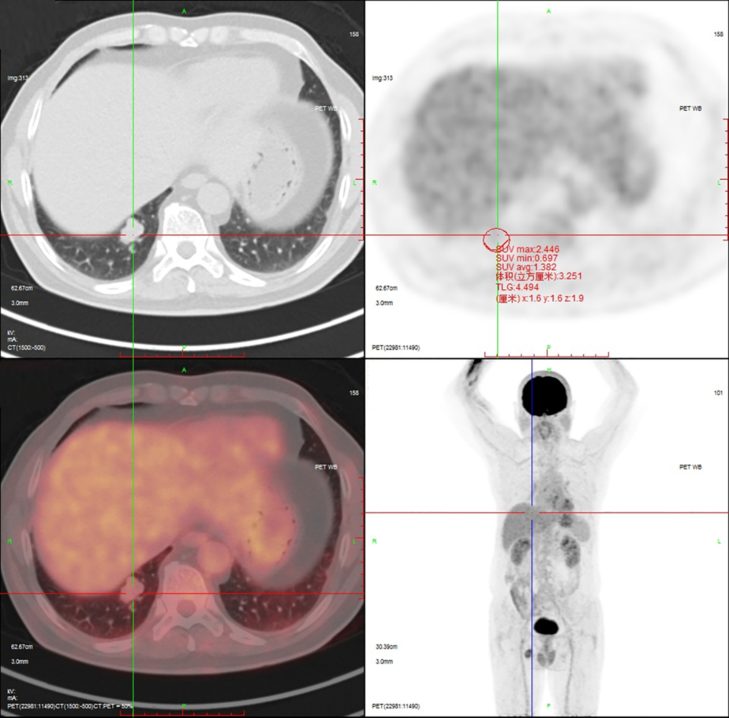 CT and PET scan images showing cross-sectional and full-body views. The top left shows a CT scan focusing on the abdomen, revealing internal organs. The top right displays a PET scan with highlighted regions of interest marked with measurements. The bottom left combines CT and PET images, showing areas of increased metabolic activity in the abdomen. The bottom right image presents a full-body PET scan with distinct areas of high uptake.