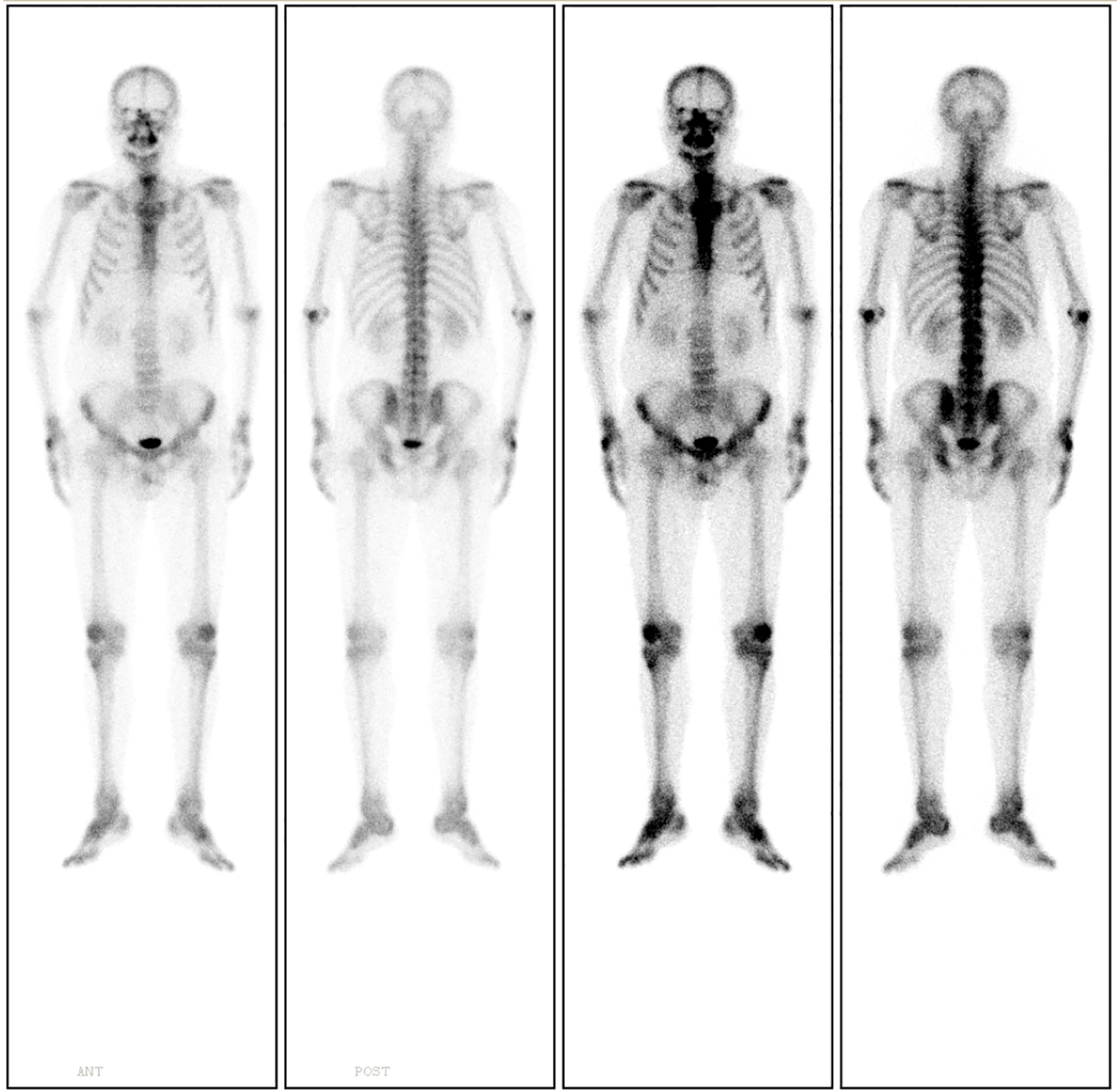 Four grayscale skeletal scans of a human figure are shown. The first two images depict anterior and posterior views with low contrast. The next two images also show anterior and posterior views, with higher contrast highlighting skeletal details.