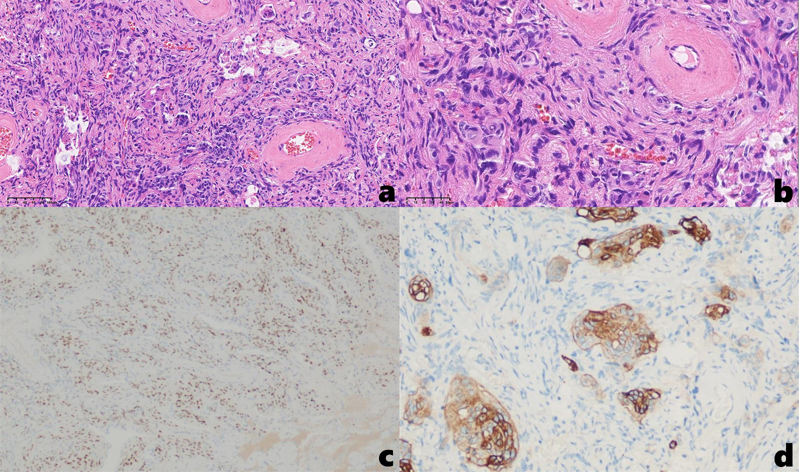 Composite image of histological slides labeled a to d. Slides a and b show tissue stained with hematoxylin and eosin, highlighting cellular structures with pink and purple tones. Slides c and d are immunohistochemical stains, with varying brown and blue staining patterns indicating protein expression in the tissue.