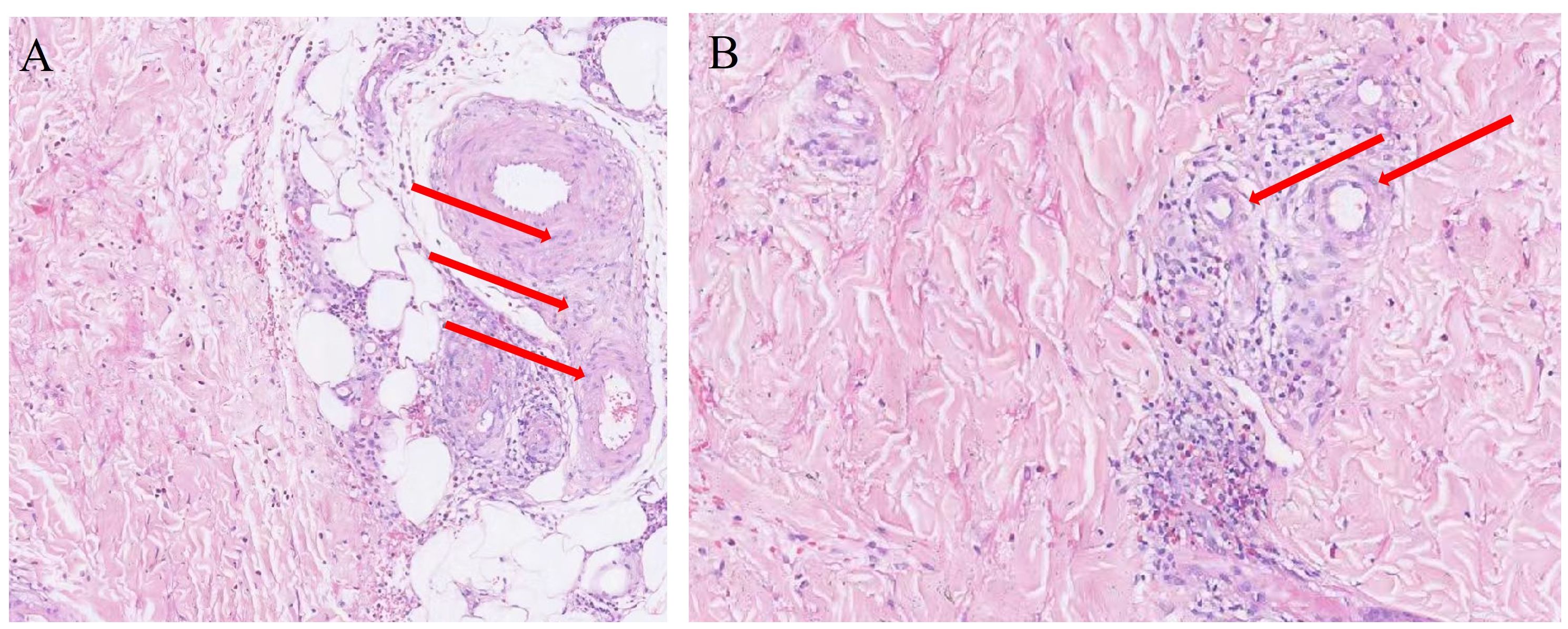 Two micrographs labeled A and B, showing tissue samples stained in pink and purple. In image A, red arrows indicate areas of interest with clustered cells and tissue structures. Image B also highlights specific cell clusters with red arrows, amidst a fibrous tissue background.