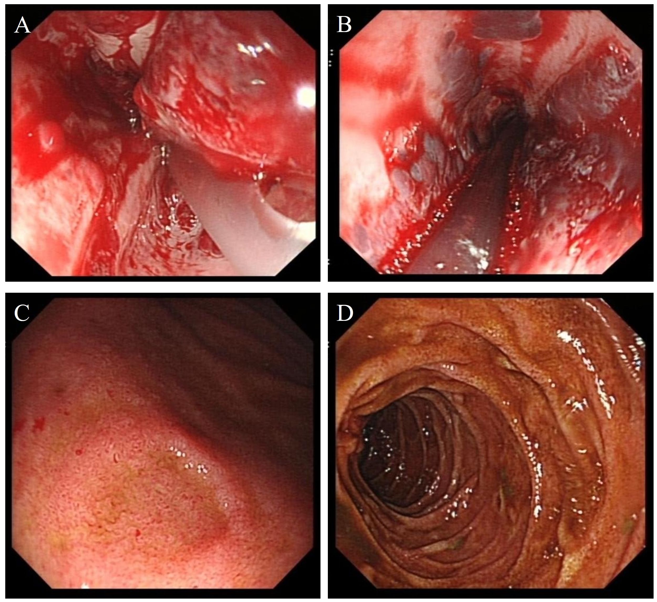 Four endoscopic images labeled A through D. Image A shows a bleeding area with visible tissue. Image B depicts a similar red and inflamed area. Image C presents a close-up of a reddish mucosal surface with scattered spots. Image D features a view down the intestinal tract with visible folds and a smooth lining.