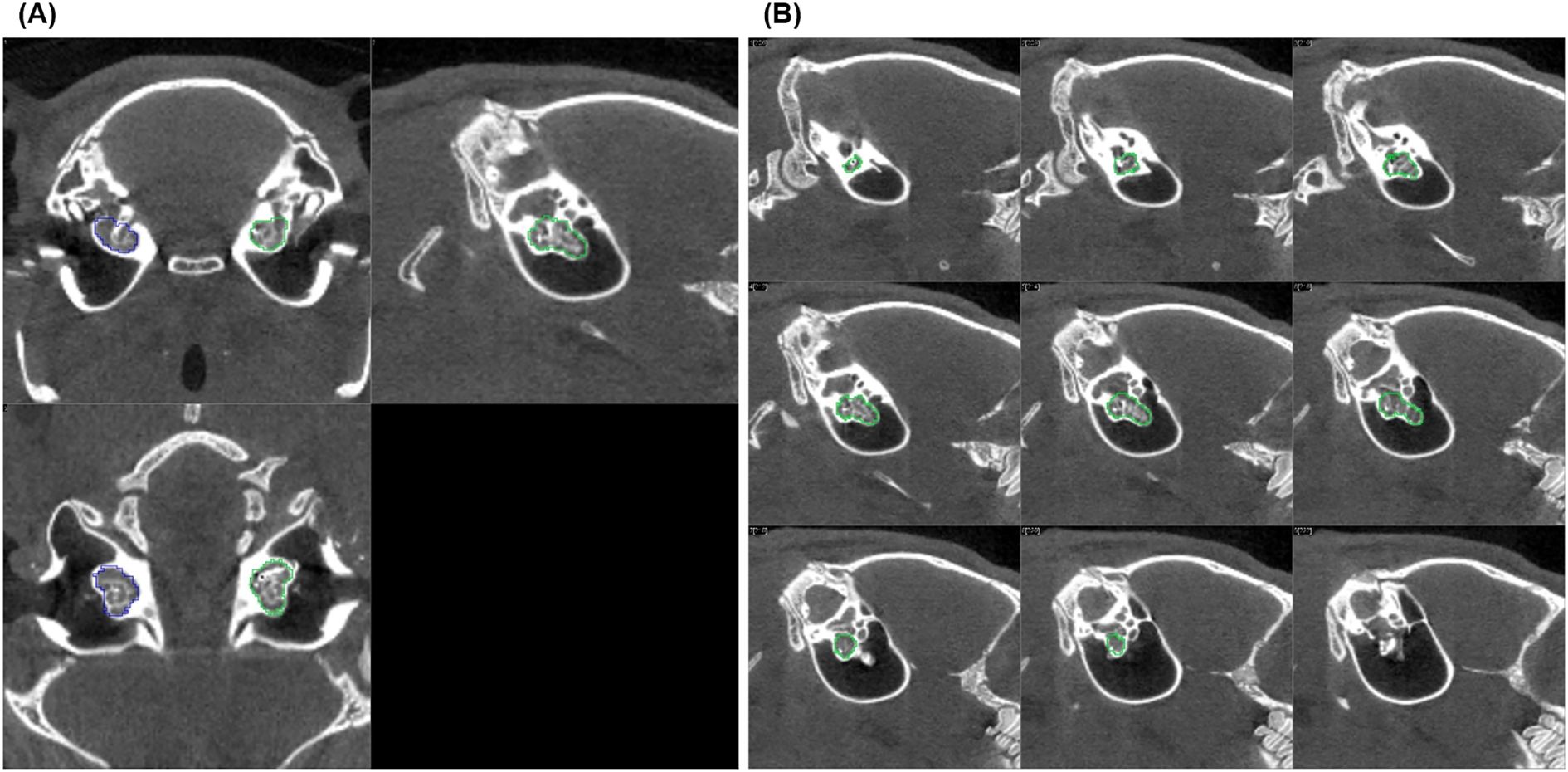 Two panels labeled A and B display CT scans of the skull. Panel A contains three axial and coronal views with blue and green outlines highlighting specific areas in the eyes. Panel B shows a series of nine sagittal views with green outlines marking particular features in each scan.
