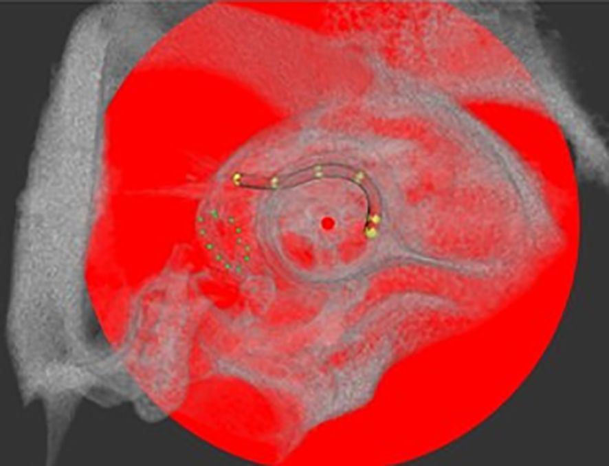 X-ray image with a bright red circular overlay showing a coiled structure within an anatomical setting. Small green and yellow markers are visible along the structure, possibly indicating measurement points or areas of interest.