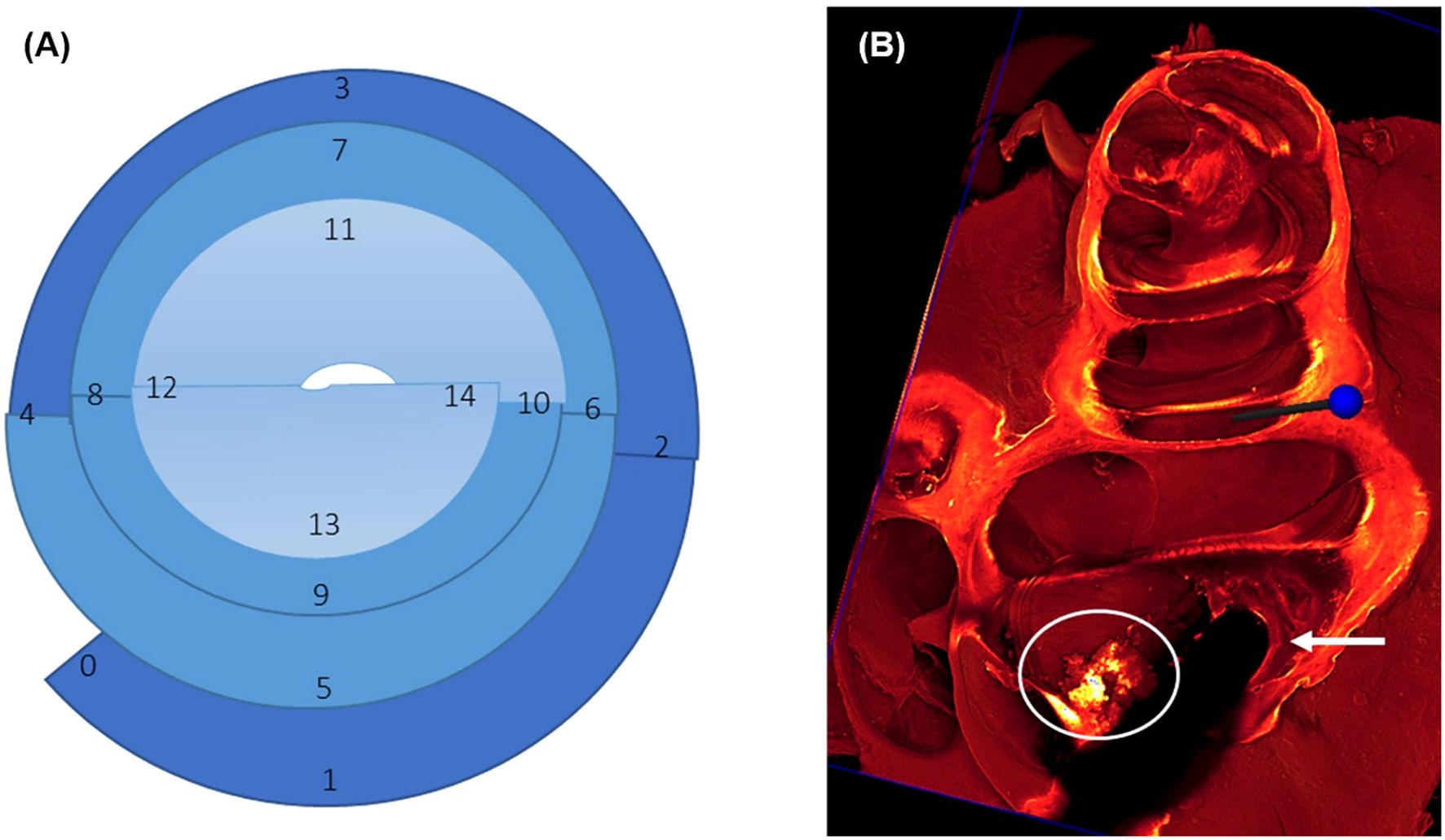 Diagram (A) shows a circular pattern divided into segments, numbered zero to fourteen, with varying shades of blue. Image (B) is a heat-map-style scan of a human abdomen with highlighted structures in red and orange. A bright area is circled at the bottom, and a white arrow points to it.