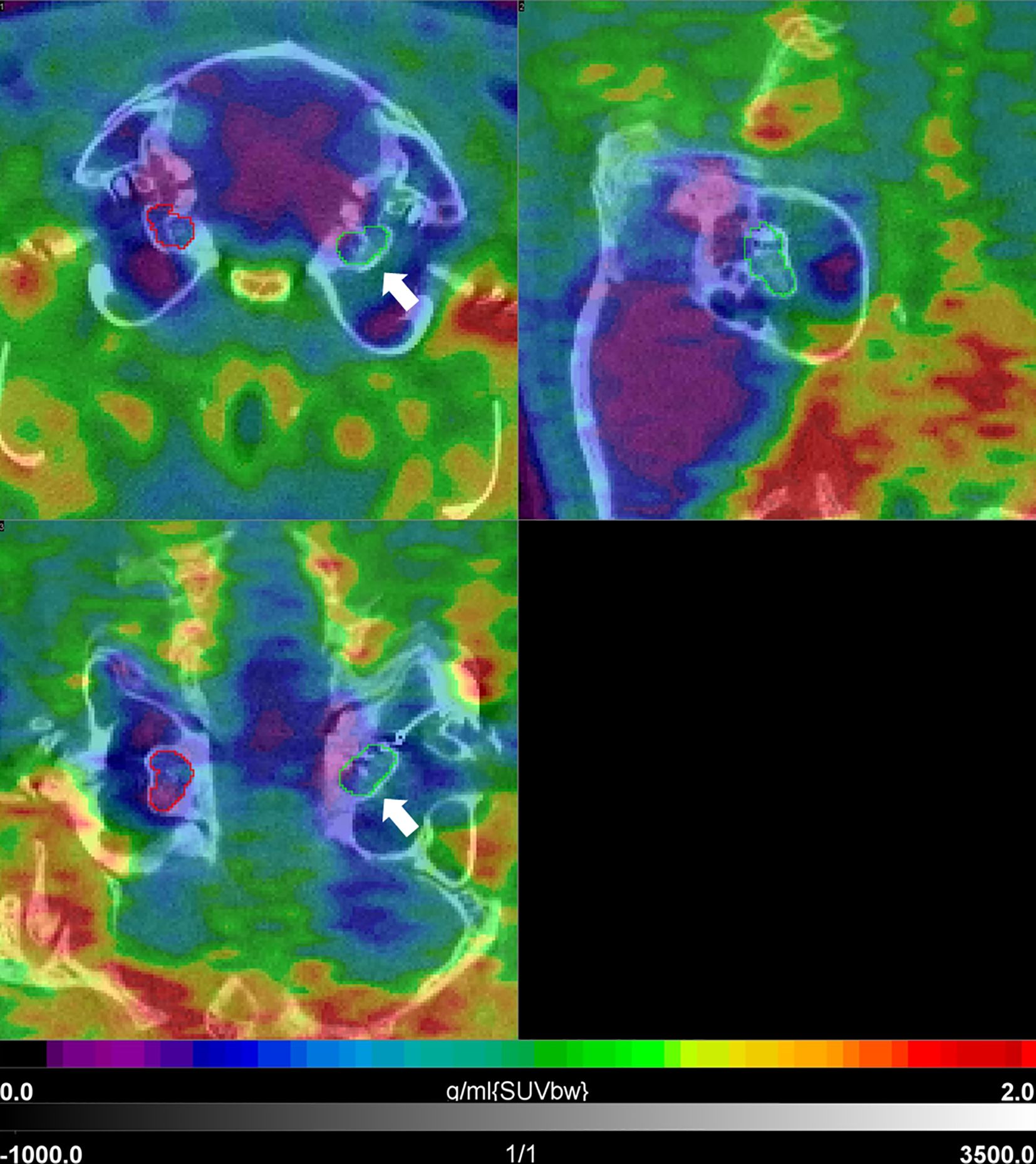Three thermographic brain scans in various orientations show color-coded regions. Blue and green dominate, with red indicating higher intensity areas. Arrows and colored outlines highlight specific sections. A color scale bar below shows intensity from negative one thousand to three thousand five hundred.