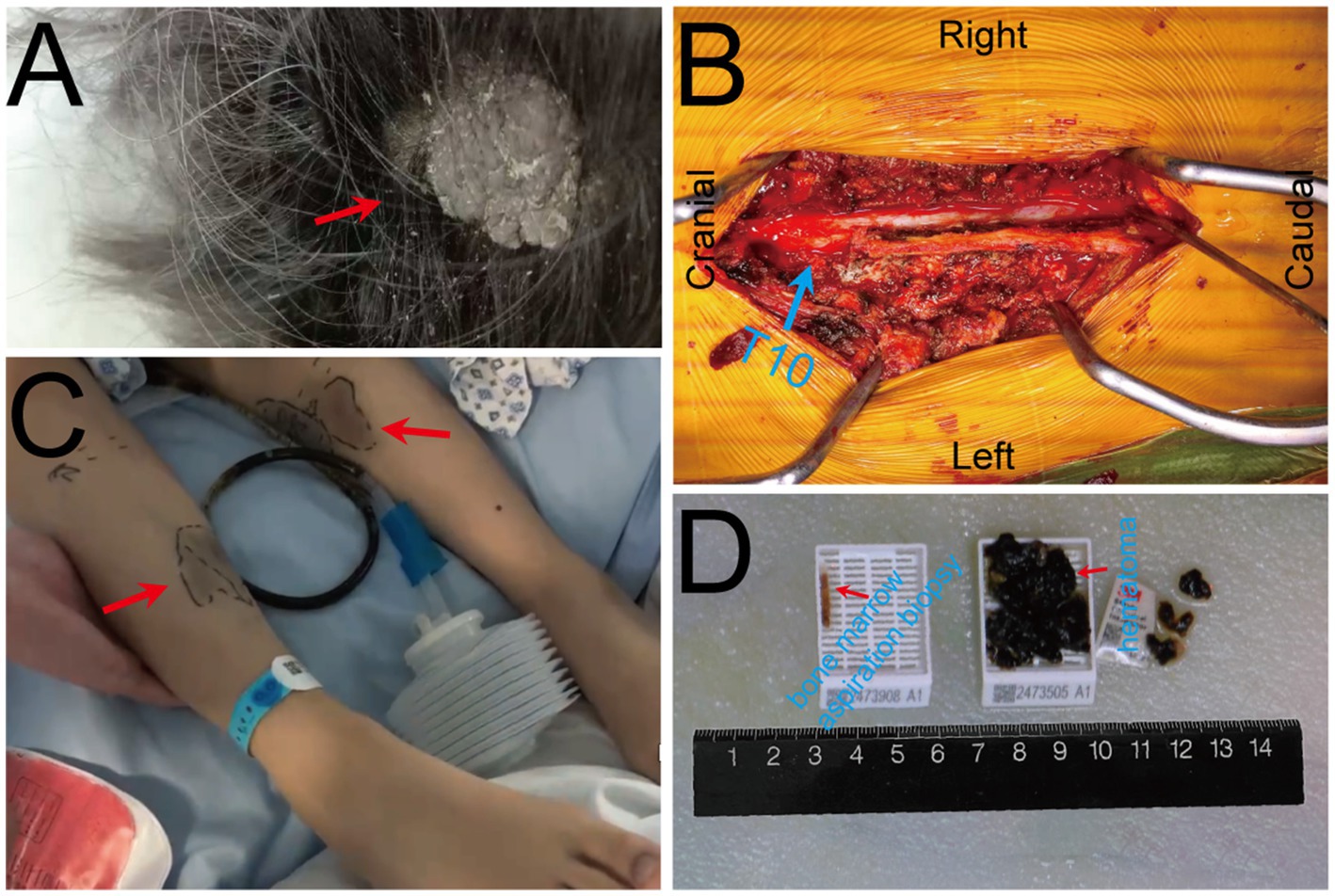 A collage with four labeled images:A: A scalp with a fungal infection indicated by a red arrow. B: A surgical view of the spine, with T10 vertebra labeled, surrounded by tissue.C: A patient's forearm with marked spots and a medical device; red arrows point to specific areas. D: Three biopsy samples next to a ruler, labeled as bone marrow aspiration biopsy and hematoma.
